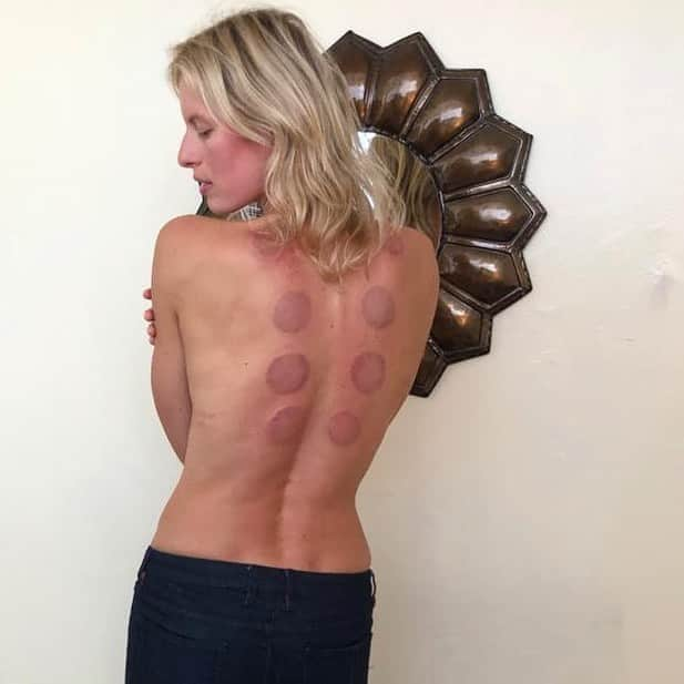 カロリナ・クルコヴァさんのインスタグラム写真 - (カロリナ・クルコヴァInstagram)「Have you guys tried cupping? Do you like it? It’s one of my favorite treatments... helps with pain, inflammation, blood flow, relaxation and your overall well-being which now more than ever is important to prioritize. @nsevhealing 💫 #naturalhealth #holistichealth #holistichealing #cupping」8月28日 1時37分 - karolinakurkova