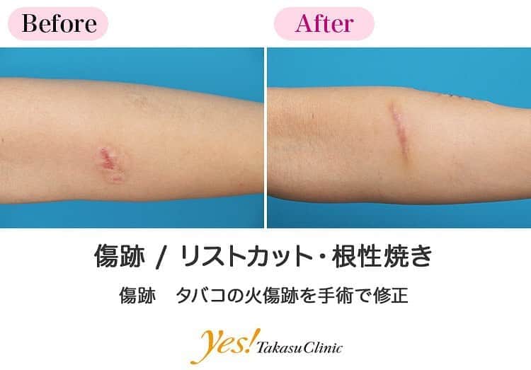 高須クリニックのインスタグラム：「👨🏻‍⚕️高須幹弥医師からのコメント✨⠀ 18歳の女の子で、就職を前になんとか根性焼きを消す方法がないかと来院されました。タバコの火傷はほぼ2列に並んでおり、この程度の幅なら切って縫うことで1本の傷にできます。ご覧のようにガラスで切ったような傷になり、これなら根性焼きとは気づかれることもありません。後ろめたい気持ちがなくなり、自信を持って就職活動をしていただけるとおもいます。 ---------------------------------------------------- 🌈料金✨⠀ ●リストカット・根性焼き（切除縫縮） 顔面の傷跡を単純に縫合する場合の目安　1cm ¥50,000 / 顔面以外の傷跡を単純に縫合する場合の目安　1cm ¥25,000【東京、横浜、名古屋、大阪】 ※また、単純に直線で縫合するのではなく、複雑な手術になる場合は料金が割増になります。※根性焼きの切除縫縮は1個¥50,000～100,000が目安です。 ●リストカット・根性焼き（アブレーション） ハガキ大 ¥500,000【東京、横浜、名古屋、大阪】 ---------------------------------------------------- ⚠️リスク・副作用・合併症✨⠀ ●リストカット・根性焼き 手術後に処方する抗生剤や痛みどめによるアレルギー症状 傷跡が肥厚性瘢痕やケロイドになる可能性 --------------------------------------------------- 😊施術についての詳細✨⠀⠀ https://www.takasu.co.jp/photo/keisei12.html ---------------------------------------------------- 📞ご予約・お問い合わせ✨⠀ 0120-5587-10⠀ https://www.takasu.co.jp/cgi-bin/form/contact.cgi ※症例写真や施術に関するご質問なども上記までお願い致します。 ---------------------------------------------------- #傷跡 #根性焼き #根性焼き消したい #タバコの火傷跡 #タバコの火傷跡を手術で修正  #皮膚 #美容 #美肌 #エイジングケア #美容整形 #美容外科 #美容クリニック #美容好き #美容皮膚科 #モニター #モニター募集 #高須クリニック #高須クリニック名古屋 #高須幹弥 #整形したい #プチ整形 #症例 #症例写真 #可愛くなりたい #可愛い #美人」