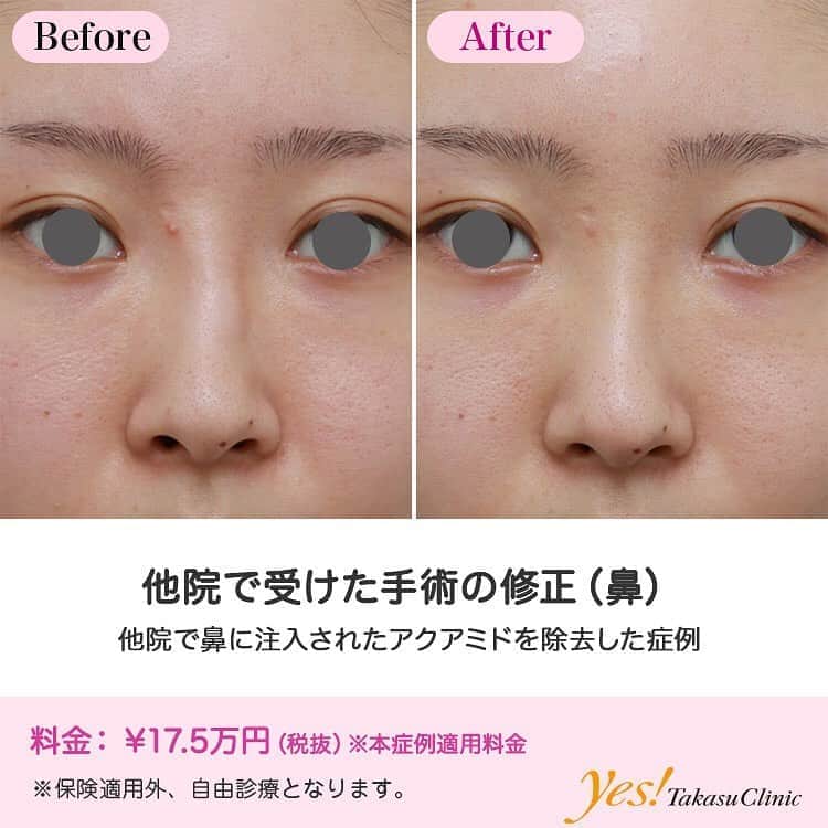 高須クリニックのインスタグラム：「👨🏻‍⚕️高須幹弥医師からのコメント✨⠀ 20代女性の患者様で、他院で鼻にアクアミドを注入されて、眉間~鼻根部にかけて凸凹に変形して、触るとブヨブヨした感触でした。 一部額まで流れて入っていました。 局所麻酔下に鼻の穴の中からアクアミドを掻き出す手術をしました。 アクアミドは皮膚の浅い部位から深い部位にかけて注入されており、深い部位に入っているものはほぼ全て掻き出すことができましたが、浅い部位に入っているものは一部真皮や皮下脂肪に浸潤して癒着しており、完全に取りきることはできませんでしたが、トータルで9割くらいは除去することができました。 浅い部位に入っているものを無理して掻き出そうとすると、その部位が窪んだり凸凹になってしまうことがあるので注意が必要です。 アクアミドはブヨブヨした軟らかいジェルなので、本来、鼻や顎などの立体感をださないといけない部位には使ってはいけないものです。 5年くらいでなくなると謳っているクリニックがありますが、基本的には永久に残る注入物なので、間違った使い方をして凸凹になってしまうと永久にそのままになってしまうことになります。 鼻に注入されたものは比較的取ることができますが（それでも完全に取りきれないことが多いです）、目の下などの皮膚の薄い部位に注入されたものはあまり取ることができないことが多いです。 鼻に注入されたアクアミドを除去する手術は高度な技術が必要であり、中途半端にやるとほとんど除去できないし、やり過ぎると凸凹になったり、縦方向の拘縮を起こしブタ鼻になってしまうことがあります。 高須クリニックでは鼻のアクアミドを除去する技術は確立しているため、悩んでいる方は一度ご相談にお越しください。 ---------------------------------------------------- 🌈料金✨⠀ ●他院で受けた手術の修正（鼻） （本症例適用料金） ¥175,000【東京、横浜、名古屋、大阪】 ※診察にてご確認ください ---------------------------------------------------- ⚠️リスク・副作用・合併症✨⠀ ●他院で受けた手術の修正（鼻） 手術後に処方する抗生剤や痛みどめによるアレルギー症状 --------------------------------------------------- 😊施術についての詳細✨⠀⠀ https://www.takasu.co.jp/photo/nose_hanaaquamid01.html ---------------------------------------------------- 📞ご予約・お問い合わせ✨⠀ 0120-5587-10⠀ https://www.takasu.co.jp/cgi-bin/form/contact.cgi ※症例写真や施術に関するご質問なども上記までお願い致します。 ---------------------------------------------------- #他院で受けた手術の修正 #アクアミド除去 #鼻修正 #鼻整形 #自然な鼻  #皮膚 #美容 #美肌 #エイジングケア #美容整形 #美容外科 #美容クリニック #美容好き #美容皮膚科 #モニター #モニター募集 #高須クリニック #高須クリニック名古屋 #高須幹弥 #整形したい #プチ整形 #症例 #症例写真 #可愛くなりたい #可愛い #美人」