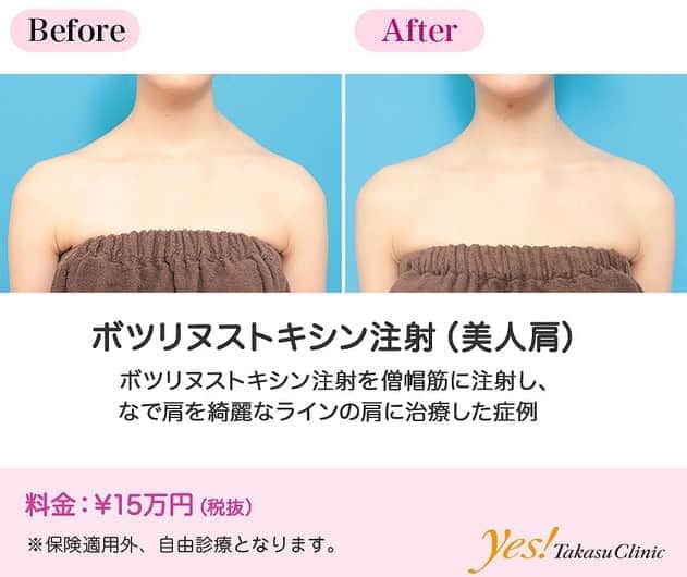 高須クリニックのインスタグラム：「👨🏻‍⚕️高須幹弥医師からのコメント✨⠀ 20代女性の患者様で、なで肩を気にされて来院されました。 診察させていただいたところ、肩の僧帽筋が大きく発達して盛り上がっており、いかつくてゴツいイメージの肩になっていました。 ウェディングドレスが似合うような綺麗なラインの肩になりたいというご要望だったので、ボツリヌストキシン注射をすることになりました。 僧帽筋の盛り上がっている部分に高濃度のボツリヌストキシン注射を多目に注射しました。 注射後2ヶ月には、僧帽筋の盛り上がっている部分が萎縮して、なだらかで綺麗なラインの肩になりました。 僧帽筋へのボツリヌストキシン注射は、なで肩、いかり肩、肩凝りの治療に用いられます。 ---------------------------------------------------- 🌈料金✨⠀ ●ボツリヌストキシン注射（美人肩） ¥150,000【全院】 ---------------------------------------------------- ⚠️リスク・副作用・合併症✨⠀ ●ボツリヌストキシン注射（美人肩） 内出血（注射針が血管に当たってしまった場合） 妊活・妊娠・授乳中の方への施術不可 --------------------------------------------------- 😊施術についての詳細✨⠀⠀ https://www.takasu.co.jp/photo/shoulder_botox01.html ---------------------------------------------------- 📞ご予約・お問い合わせ✨⠀ 0120-5587-10⠀ https://www.takasu.co.jp/cgi-bin/form/contact.cgi ※症例写真や施術に関するご質問なども上記までお願い致します。 ---------------------------------------------------- #ボツリヌストキシン注射 #美人肩 #綺麗なラインの肩 #なで肩 #なで肩の治療  #皮膚 #美容 #美肌 #エイジングケア #美容整形 #美容外科 #美容クリニック #美容好き #美容皮膚科 #モニター #モニター募集 #高須クリニック #高須クリニック名古屋 #高須幹弥 #整形したい #プチ整形 #症例 #症例写真 #可愛くなりたい #可愛い #美人」