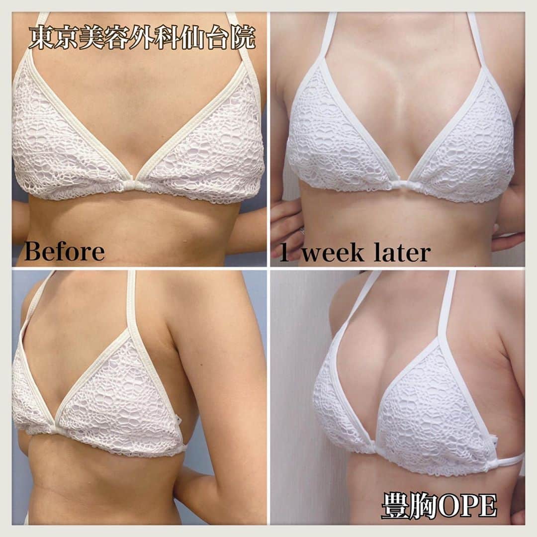 東京美容外科公式のインスタグラム：「👙東京美容外科仙台院です👙 こちらは仙台院院長の加藤Drによる豊胸OPE後、1週間後の方の症例です☺️ 正面だけでなく、サイドから見てもふっくらバストになって水着を着た時のサイズ感が嬉しいですよね💖 ・ バストのお悩みがある方、一度ご相談してみませんか？ サイズや施術方法も含めて、ドクターが皆様のお悩みに合わせてカウンセリング致しますのでぜひご相談下さい💁🏻‍♀️✨ ・ 当院では政府の緊急事態宣言をうけて ❇️ウェブカウンセリングを開始 ならびに ❇️メディカルコスメ、サプリが郵送での購入を開始致しました。 ※当院に一度でもご来院いただいたことのある方は、郵送可能です🙇‍♀️  ・ 🌷ウルトラセルQプラス ¥70,000(初回) 🌷ヴェルベットスキン ¥45,000(初回）  ・ その他メニュー各種ございます😊💕 お気軽にお問い合わせくださいませ🍏🍎 各線「仙台駅」より徒歩5分、JR仙石線「あおば通駅」より徒歩2分 ♡ 東京美容外科 仙台院にぜひお越しください！😇 . . ====🎁お問い合わせはこちら🎁==== 詳しくはプロフィールのURLから公式サイトへ♪ ▼フリーダイヤル 0120-658-958 （コールセンター受付時間：9：00～21：00） ▼LINE予約 @ tkc110 ========================= . #東京美容外科 #東京美容外科仙台院 #仙台 #宮城 #美容 #美容整形 #整形 #美活 #綺麗になりたい #美肌 #美意識  #美容外科 #プチ整形 #エイジングケア #アンチエイジング #美容好き #韓国美容 #美容整形外科 #ヒアルロン酸 #鼻整形 #二重 #埋没 #埋没法 #豊胸 #豊胸手術 #バストアップ #バスト #webカウンセリング始めました #東美東北胸」