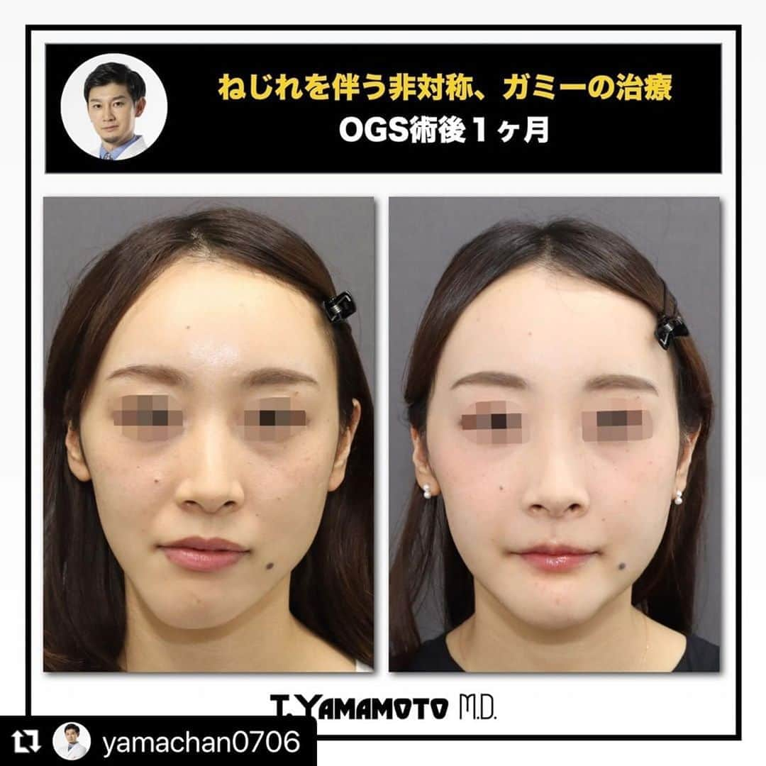 東京美容外科公式さんのインスタグラム写真 - (東京美容外科公式Instagram)「#Repost @yamachan0706 with @make_repost ・・・ ★★★ねじれを伴う複雑な非対称とガミースマイルを同時に治すOGS術後1ヶ月★★★ ★３Dシミュレーションで正確なポジション取りをすることで丁寧に治していく★  以前CTのお写真を出した患者様の術後経過になります。 ネジレを伴う複雑な非対称とガミースマイルの治療です。 矯正医とかみ合わせの位置を打ち合わせし、３Dシミュレーションできっちり真っ直ぐになるように丁寧に術中の顎の位置を決めていきます。  また少し長めのお顔をガミースマイルの改善と同時に治療しています。 最後にオトガイ形成を行うことでE-lineと非対称治療の画竜点睛としています。  こういう捻じれのある非対称の患者様は極めて3次元的に高度な骨移動の仕方になるため、３Dシミュレーションでの綿密な計画をたててくれるところでしか手術を受けては行けないと思います。  我々は、３Dシミュレーションで作成したデータを元に３Dプリンターで作成したマウスピースを用いることで実際の手術を正確に行えるような工夫を行っています。  非対称の治療というのは非常に奥深く、治療する私達としても非常にやりがいのある治療です。 非対称にお悩みの方は、お力になれるかもしれません。 是非一度ご相談ください。  /////////////////////////////////////////////////////////////////////////////////////////////////////  カウンセリングは東京美容外科のコールセンター、LINE予約などから受け付けております。 また、Webカウンセリングなどもぜひご利用ください。  /////////////////////////////////////////////////////////////////////////////////////////////////////  /////////////////////////////////////////////////////////////////////////////////////////////////////  ＜行った施術＞ Le Fort Ⅰ型骨切り＋SSRO+＋オトガイ形成（短縮、左方移動）＋Vライン形成  ＜リスク＞ 下口唇の痺れ プレート感染 後戻り 血腫、後出血 鼻閉 開口制限 咬合不正など  /////////////////////////////////////////////////////////////////////////////////////////////////////  #整形美人 #小顔美人 #小顔整形 #顔痩せ #外科矯正 #受け口 #下顎前突 #口元美人 #顎変形症 #ルフォー #lefort #顔面非対称 #輪郭手術 #輪郭整形 #整形垢さんと繋がりたい #美容垢さんと繋がりたい #両顎手術 #形成外科専門医 #骨切り山ちゃん #小顔になりたい #小顔美容矯正 #顔でかい #顔でか #顔やせ #eライン #整形したい #横顔美人 #横顔フェチ #顔の歪み」8月28日 14時36分 - tokyobiyougeka_jimukyoku