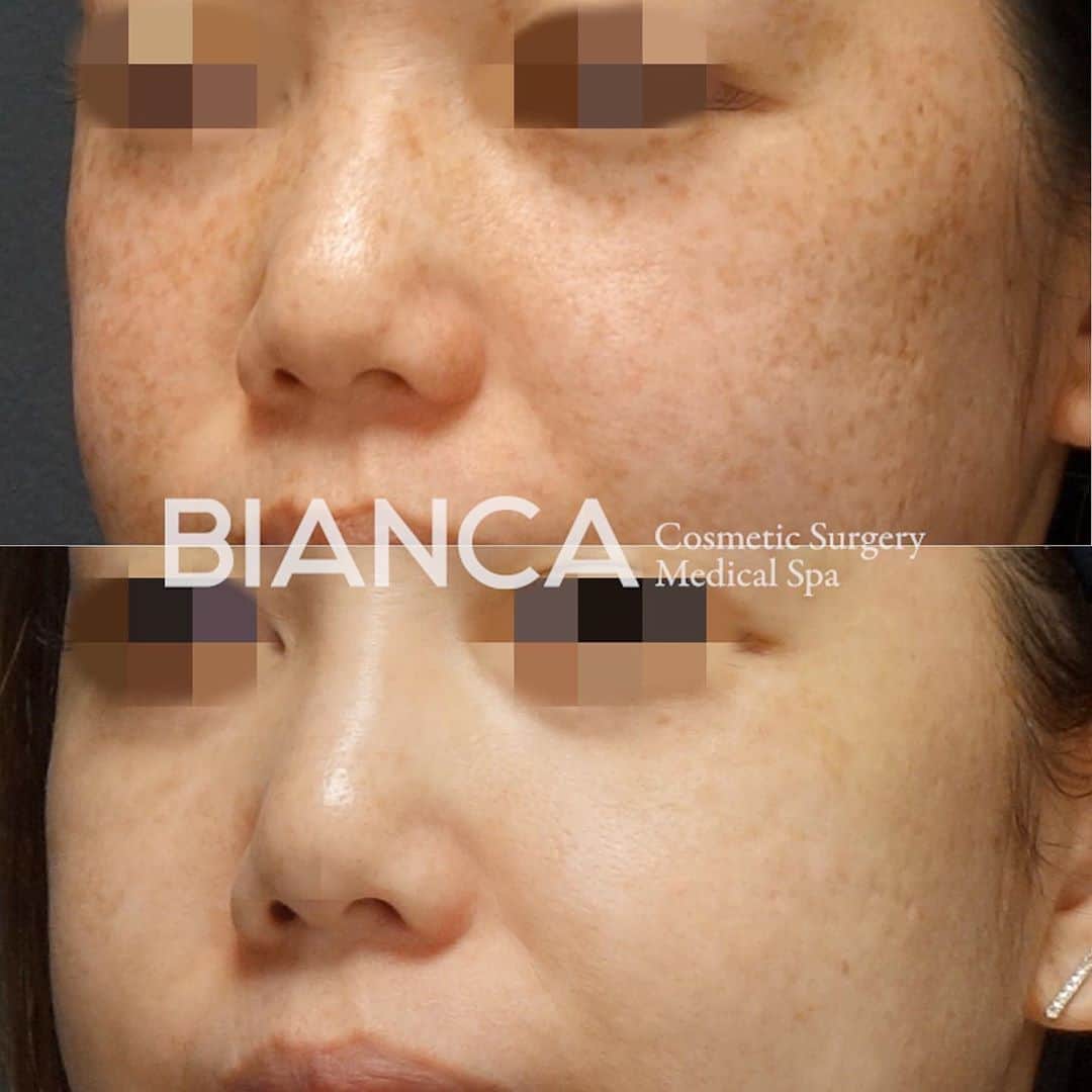 のインスタグラム：「【これぞBIANCAメソッド🌟】﻿ ﻿ 上 治療前﻿ 下 スポット照射 ＋トーニング10回後﻿ ﻿ 色素が改善されるだけでなく 回を重ねるごとに、肌のキメも細やかになってきます🙌❣️﻿ ﻿ 1人で悩んでいる時間はもったいないです❗️😵⭐﻿ 気になる方は是非カウンセリングにお越しください☺️️﻿ ﻿ 💴 ピコスポット 全顔 98,000円﻿ 💉麻酔: 表面麻酔﻿ 😷DT: シミの黒浮き1週間程度﻿ ⚠️リスク: 色素脱失・色素沈着・水泡形成など﻿ 💴ピコトーニング 14,800円/回﻿ ﻿ 🉐モニター募集中‼️ ﻿ ⚠️ご予約の際は﻿ 『Dr Yuu（辻沢）のインスタ見た』の一言をお願いします👩‍⚕️✨﻿ ﻿ 📍BIANCA CLINIC﻿ ✔︎表参道院﻿ 03-6433-5994﻿ 東京都港区南青山5-11-10  南青山511ビル 2F﻿ ✔︎銀座院﻿ 03-6263-2690 ﻿ 東京都中央区銀座1-5-6 銀座レンガ通り福神ビル 4F﻿ ﻿ 診療時間 10:00〜19:00﻿ 年中無休（年末年始を除く）﻿ 🔜﻿ ﻿ 9月勤務日🎑﻿ 表参道院﻿ ↪︎1 3 6 14 16 21 22 24 27 30﻿ 銀座院﻿ ↪︎2 5 17 18 20 25 26﻿ ﻿ #plasticsurgery #cosmeticsurgery  #美容外科 #美容皮膚科 #美容整形 #プチ整形 #美肌 #美魔女 #美容 #アンチエイジング  #picosure #ピコシュア #ピコトーニング #ピコフラクショナル #ビアンカクリニック #dryuu #シミ取り #そばかす #シミ治療 #dryuu肌 #ソバカス #スキンケア #美白 #biancaclinic #ビアンカクリニック #レーザートーニング #モニター募集 #モニター募集中 #followｍe #フォローミー」