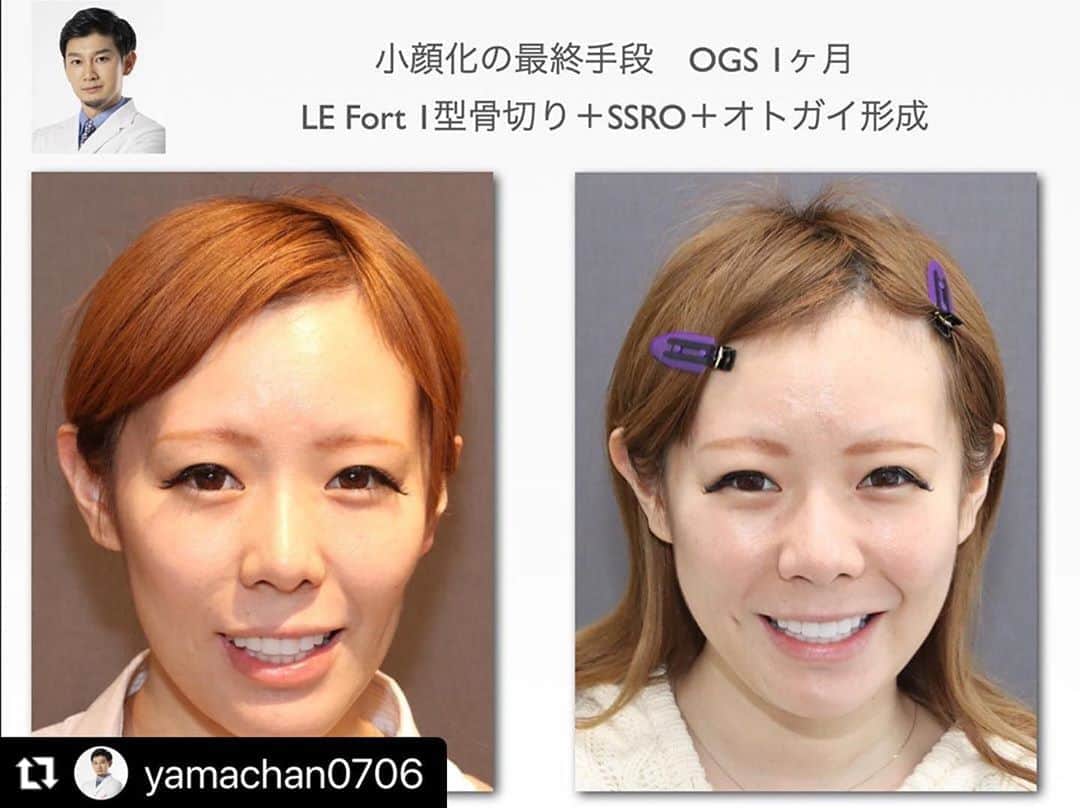 東京美容外科公式さんのインスタグラム写真 - (東京美容外科公式Instagram)「#Repost @yamachan0706 with @make_repost ・・・ 顔の長さを治したい小顔の最終手段OGS術後1ヶ月﻿ ﻿ コロナ渦中で、大学病院のオペがとどこっております。鼻や大きな骨のオペがたくさん飛んで患者さんには多大なご迷惑をおかけしております。﻿ ﻿ このような状況で輪郭のカウンセリングにお越しいただくのもあれですので、ウェブカウンセリングを始めておりますので、ぜひこの機会にご利用ください。﻿ ﻿ ﻿ さて、OGS（両顎手術、Le Fort1型＋SSRO）で小顔化を図る方法はいくつかあります。﻿ それぞれを組み合わせることで、あまり条件がよくない場合でも小顔化を図れることがあります。﻿ 逆に、小顔化の条件がいいケースは簡単に言うと、シャクレとガミースマイルのケースです。﻿ ﻿ 今回のケースはガミースマイルも少しだけ、シャクレでもないケースですが、上顎の移動と回転を工夫することでなるべく小顔化を図ったケースです。﻿ 例によって、薄くなる唇は後日なんとかしようかとお話済です。﻿ 童顔系のお顔になりましたね。おそらく3ヶ月にかけて腫れが更に引くので、顔のお肉のボリュームを見ながら追加で脂肪注入などをするとより可愛らしい感じになるかもしれません。﻿ ﻿ 美しいE-lineはOGSの手術、鼻のオペを行えば基本的には誰でも手に入るものです。﻿ 悩まれている方は一度ご相談ください。﻿ ﻿ ﻿ ＜行った施術＞﻿﻿ Le Fort Ⅰ型骨切り＋SSRO+オトガイ形成﻿ ﻿﻿ ＜リスク＞﻿﻿ 下口唇の痺れ﻿﻿ プレート感染﻿﻿ 後戻り﻿﻿ 血腫、後出血﻿﻿ 鼻閉﻿﻿ 開口制限﻿﻿ 咬合不正など﻿﻿ ﻿﻿ ﻿﻿ ﻿﻿﻿ #顔面非対称#受け口#美容外科 #輪郭手術 #輪郭#形成外科専門医#オトガイ形成 #矯正 #矯正治療#3dシミュレーション #ガミースマイル #しゃくれ#小顔矯正 #小顔マッサージ #コルギ #小顔整形 #顎変形症#美容 #美容マニア#美容好きな人と繋がりたい #bimax#gummysmile#facialasymmetry#サージェリーファースト#surgeryfirst 両顎手術#イケメン#ホスト#キャバクラ#骨切り山ちゃん﻿」8月29日 14時00分 - tokyobiyougeka_jimukyoku