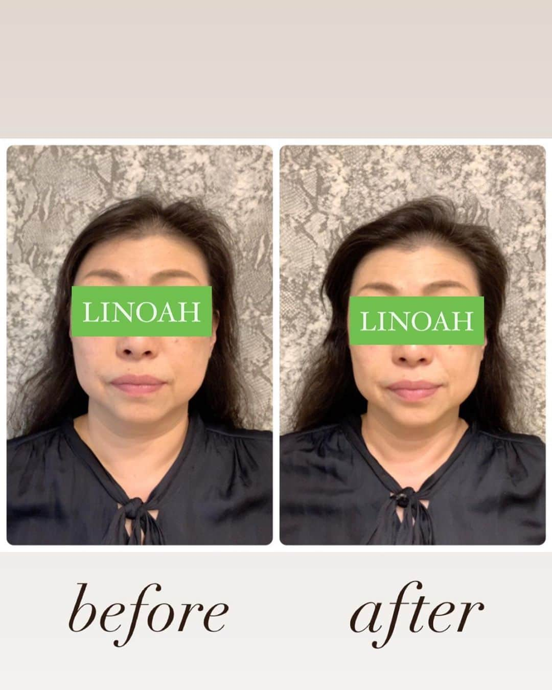 Beauty Salon LINOAHさんのインスタグラム写真 - (Beauty Salon LINOAHInstagram)「・  ３D HIFU（ハイフ）﻿ ⭐️モニターキャンペーン募集中⭐️﻿ 1回5000円でお受け頂けます！！﻿ ﻿ ご興味がある方は是非、ご予約お問い合わせいただければと思います。﻿ ﻿ ﻿ 脱毛・フェイシャルBeautySalon　LINOAH　　　　　　　　﻿ 大阪梅田の脱毛・フェイシャル完全予約制のプライベートサロン　　﻿ 男女　性別問わずご利用頂けます。﻿  ﻿  ﻿ 【アクセス】﻿  ﻿ 大阪市北区鶴野町4-11　朝日プラザ914﻿ 阪急 梅田駅茶屋町口 徒歩 5分﻿  ﻿ 【営業時間】﻿ 平日　11:00～22:00（最終受付21：30）﻿ 土日祝　11:00～20:00（最終受付19：30）﻿ ※完全予約制となっております。﻿  ﻿ 【定休日】﻿ 毎週木曜日﻿  ﻿ ご予約はこちらへ﻿ 電話：06-6110-5067 ﻿ ﻿ ﻿ #大阪 #梅田 #脱毛 #メンズ脱毛 ﻿ #レディース脱毛 #フェイシャル #エステ #beautysalonlinoah ﻿ #ビューティーサロンリノア ﻿ #プライベートサロン ﻿ #フォトフェイシャル ﻿ #男性 #女性 #lgbt ﻿ #安心 #美肌 #美白 #しみ #シワ ﻿ #ニキビ #ニキビ跡 ﻿ #リフトアップ #小顔 #ハイフ#HIFU﻿ #ヒゲ #顔 #青ひげ #カミソリ負け #美意識 ﻿」8月29日 21時44分 - beautysalon_linoah