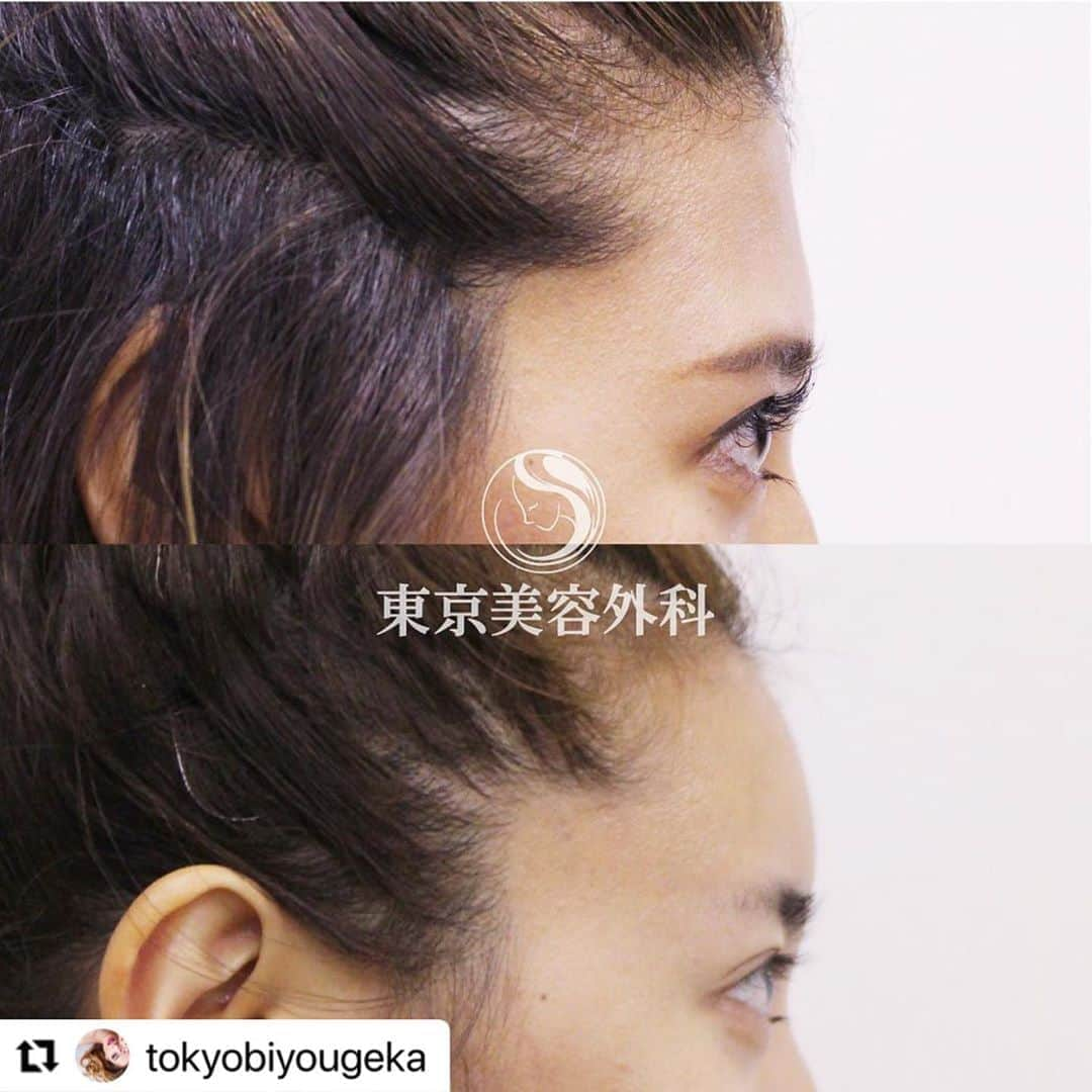 東京美容外科公式さんのインスタグラム写真 - (東京美容外科公式Instagram)「#Repost @tokyobiyougeka with @make_repost ・・・ 額ヒアルロン酸注入の症例写真です✨ ㅤㅤㅤㅤㅤㅤㅤㅤㅤㅤㅤㅤ おでこヒアルロン酸が大変人気です♡ まあるいおでこは女性らしさの象徴♡ ㅤㅤㅤㅤㅤㅤㅤㅤㅤㅤㅤㅤ そんな憧れのまあるいおでこがヒアルロン酸で簡単につくれます✨ おでこのシワにお悩みのかたにもおすすめです✨ 初回1本56,000円～（税抜） ㅤㅤㅤㅤㅤㅤㅤㅤㅤㅤㅤㅤ WEBカウンセリングも大好評受付中！ドクターの指名もOKです✨ ㅤㅤㅤㅤㅤㅤㅤㅤㅤㅤㅤㅤ 是非、一度ご相談くださいませ✨ ㅤㅤㅤㅤㅤㅤㅤㅤㅤㅤㅤㅤ ご予約の際は、インスタグラムを見たとお伝えください💁🏻‍♀️💓 ㅤㅤㅤㅤㅤㅤㅤㅤㅤㅤㅤㅤㅤㅤㅤㅤ 【東京美容外科】 ====□お問い合わせはこちら□===== ▼フリーダイヤル ☎0120-658-958 （コールセンター受付時間：9：00～21：00） . ▼LINE予約 @ tkc110 ============= ㅤㅤㅤㅤㅤㅤㅤㅤㅤㅤㅤㅤ #東京美容外科 #ヒアルロン酸　#美容メンテナンス #額ヒアルロン酸 #おでこヒアルロン酸 #まあるいおでこ #横顔 #横顔美人 #額」8月30日 17時13分 - tokyobiyougeka_jimukyoku