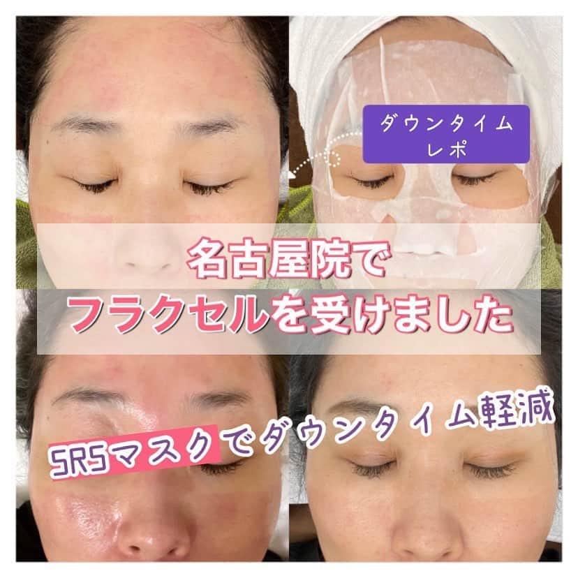 オラクル美容皮膚科東京新宿院さんのインスタグラム写真 - (オラクル美容皮膚科東京新宿院Instagram)「毛穴レーザー治療『フラクセル』﻿ ダウンタイムレポート✍️﻿ ﻿ 9月に入りそろそろレーザー治療を開始したいという方も多いかと思います。﻿ ﻿ 先日名古屋院でフラクセルを受けたのでダウンタイムの経過をご紹介‼️﻿ ※ダウンタイムは個人差がありますので参考までに😉﻿ ﻿ 今回は時間があまりなく、再生管理はできなかったのでSRSでアフターケアをすることに…﻿ ﻿ フラクセル直後SRSマスク◎﻿ ↓﻿ 当日の夜はかなり赤みが出ました😢﻿ ↓﻿ ところが翌日は驚くほど赤みが引きました👏﻿ ﻿ 数日はフラクセルの跡がお肌に残りダウンタイムはありますが、赤みが早く引いたのであまり気にならずダウンタイムを過ごせました！﻿ ﻿ フラクセル後や水光注射の後は﻿ SRSマスクでのアフターケアがおすすめです👉﻿ ﻿ 施術後の敏感になっているお肌へを鎮静しダウンタイムを軽減します。﻿ さらに美容成分でお肌の回復力が本当に変わります。﻿ ﻿ さらに施術後3日後にもSRSマスクでケア﻿ 施術後はだけではなく、普段のスキンケアの﻿ スペシャルケアとしても欠かせません。﻿ ﻿ SRSマスクパックとは、自然由来の保湿成分を配合やヒト臍帯血幹細胞順化培養液を配合したお肌の若返りマスク ✨﻿ ﻿ 成長因子（サイトカイン）が肌を活性化し、コラーゲンを増生させます😍﻿ ﻿ 💎SRSマスクは3種類💎﻿ ※下記は税抜き価格となります。﻿ ﻿ ❶SRSマスク メディ﻿ 【価格】1枚　¥2,800﻿ ﻿ 【特徴】﻿ ✅ヒト臍帯血幹細胞順化培養液を5,000PPM配合し﻿ ✅お肌の角質層にまで浸透し、細胞レベルで皮膚に潤いを与えるます。﻿ ✅肌荒れを防ぎ、お肌に潤いをしっかりと与え健康液なお肌へ導くマスク﻿ ﻿ ﻿ ❷SRSマスク　プラス﻿ 【価格】1枚　¥2,000﻿ ﻿ 【特徴】﻿ ✅ヒアルロン酸、肌の弾力や維持・傷痕の治療時に活躍する成長因子などの成分を配合﻿ ✅年齢と共に減少する成長因子を与えお肌に若々しさを引き戻します。﻿ ﻿ ﻿ ❸SRSマスク　べべ﻿ 【価格】1枚　¥2,500（税込）﻿ ﻿ 【特徴】﻿ ✅自然由来の保湿成分を配合やヒト臍帯血幹細胞﻿ 順化培養液を配合したお肌の若返りマスク﻿ ✅肌荒れを防ぎ、お肌に潤いをしっかりと与え健康液なお肌へ導くマスクです。﻿ ﻿ ﻿ スタッフも愛用のSRSマスクです🥰﻿ ﻿ ﻿ ﻿ #オラクル美容皮膚科 #オラクル ﻿ #oracle #韓国美容 #美容皮膚科 ﻿ #皮膚科 #美容 #フラクセル　#フラクショナルレーザー #美容オタク #美容マニア  #ヒアルロン酸 #弾力 #ハリ #美白 #保湿 #ゆらぎ肌 #일본피부과 #오라클피부과  #美肌 #美肌ケア #肌管理 #韓国美容皮膚科 #乾燥 #成長因子 #srsマスク #ドクターズコスメ #医療専売品」8月31日 9時58分 - oraclejp