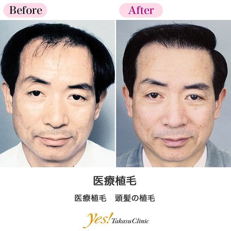 高須クリニックのインスタグラム：「👨🏻‍⚕️高須幹弥医師からのコメント✨⠀ 50代の男性です。年齢とともに後退してきた生え際が気になり、約600本植毛しました。 単一植毛によって1本1本丁寧に植毛するので、とても自然な仕上がりに。一番気になっていた部分を増やすことにより、効率よく悩みを改善できました。生え際に髪があるだけで、ずいぶん印象が変わりましたよね。 男性ホルモンの影響で生え際は薄くなりやすいのですが、後頭部は年をとっても毛が残りやすい部分。もっと生え際をふさふさにしたいなら、後頭部から取る毛がある限り何度でも植毛することができます。 ---------------------------------------------------- 🌈料金✨⠀ ●医療植毛・育毛　頭部 50本 ¥700,000 / 100本 ¥900,000 / 200本 ¥1,000,000 / 300本 ¥1,100,000 / 400本 ¥1,200,000 / 600本 ¥1,300,000 / 800本 ¥1,500,000 / 1,000本 ¥1,600,000【東京、横浜、名古屋、大阪】 ---------------------------------------------------- ⚠️リスク・副作用・合併症✨⠀ ●医療植毛 手術後に処方する抗生剤や痛みどめによるアレルギー症状 --------------------------------------------------- 😊施術についての詳細✨⠀⠀ https://www.takasu.co.jp/photo/hair06.html ---------------------------------------------------- 📞ご予約・お問い合わせ✨⠀ 0120-5587-10⠀ https://www.takasu.co.jp/cgi-bin/form/contact.cgi ※症例写真や施術に関するご質問なども上記までお願い致します。 ---------------------------------------------------- #医療植毛 #頭髪の植毛 #植毛 #薄毛 #単一植毛  #皮膚 #美容 #美肌 #エイジングケア #美容整形 #美容外科 #美容クリニック #美容好き #美容皮膚科 #モニター #モニター募集 #高須クリニック #高須クリニック名古屋 #高須幹弥 #整形したい #プチ整形 #症例 #症例写真 #可愛くなりたい #可愛い #美人」