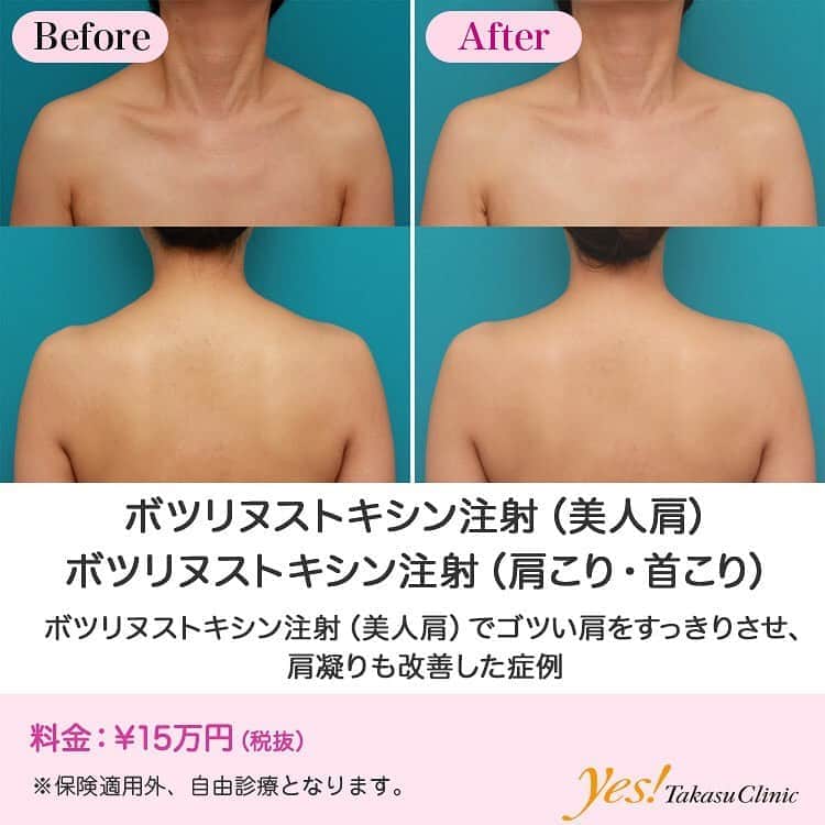 高須クリニックのインスタグラム：「👨🏻‍⚕️高須幹弥医師からのコメント✨⠀ 30代女性で、僧帽筋が発達し、ゴツい印象のなで肩になっているのを気にされていました。 また、慢性的な肩凝りにも悩まされていました。 僧帽筋の発達して盛り上がっている部分にボツリヌストキシン注射をし、すっきりさせることになりました。 合わせて、肩凝りのトリガーポイントになっている部位にもボツリヌストキシン注射をしました。 注射後1週間くらいで、徐々に肩凝りが楽になり、1ヶ月後にはゴツくていかつい感じだったなで肩が、女性らしいすっきりした肩になりました。 ---------------------------------------------------- 🌈料金✨⠀ ●ボツリヌストキシン注射（美人肩） ¥150,000【全院】 ---------------------------------------------------- ⚠️リスク・副作用・合併症✨⠀ ●ボツリヌストキシン注射（美人肩） 内出血（注射針が血管に当たってしまった場合） 妊活・妊娠・授乳中の方への施術不可 --------------------------------------------------- 😊施術についての詳細✨⠀⠀ https://www.takasu.co.jp/photo/shoulder_botox03.html ---------------------------------------------------- 📞ご予約・お問い合わせ✨⠀ 0120-5587-10⠀ https://www.takasu.co.jp/cgi-bin/form/contact.cgi ※症例写真や施術に関するご質問なども上記までお願い致します。 ---------------------------------------------------- #ボツリヌストキシン注射 #美人肩 #肩凝り改善 #女性らしいすっきりした肩 #なで肩 #僧帽筋  #皮膚 #美容 #美肌 #エイジングケア #美容整形 #美容外科 #美容クリニック #美容好き #美容皮膚科 #モニター #モニター募集 #高須クリニック #高須クリニック名古屋 #高須幹弥 #整形したい #プチ整形 #症例 #症例写真 #可愛くなりたい #可愛い #美人」