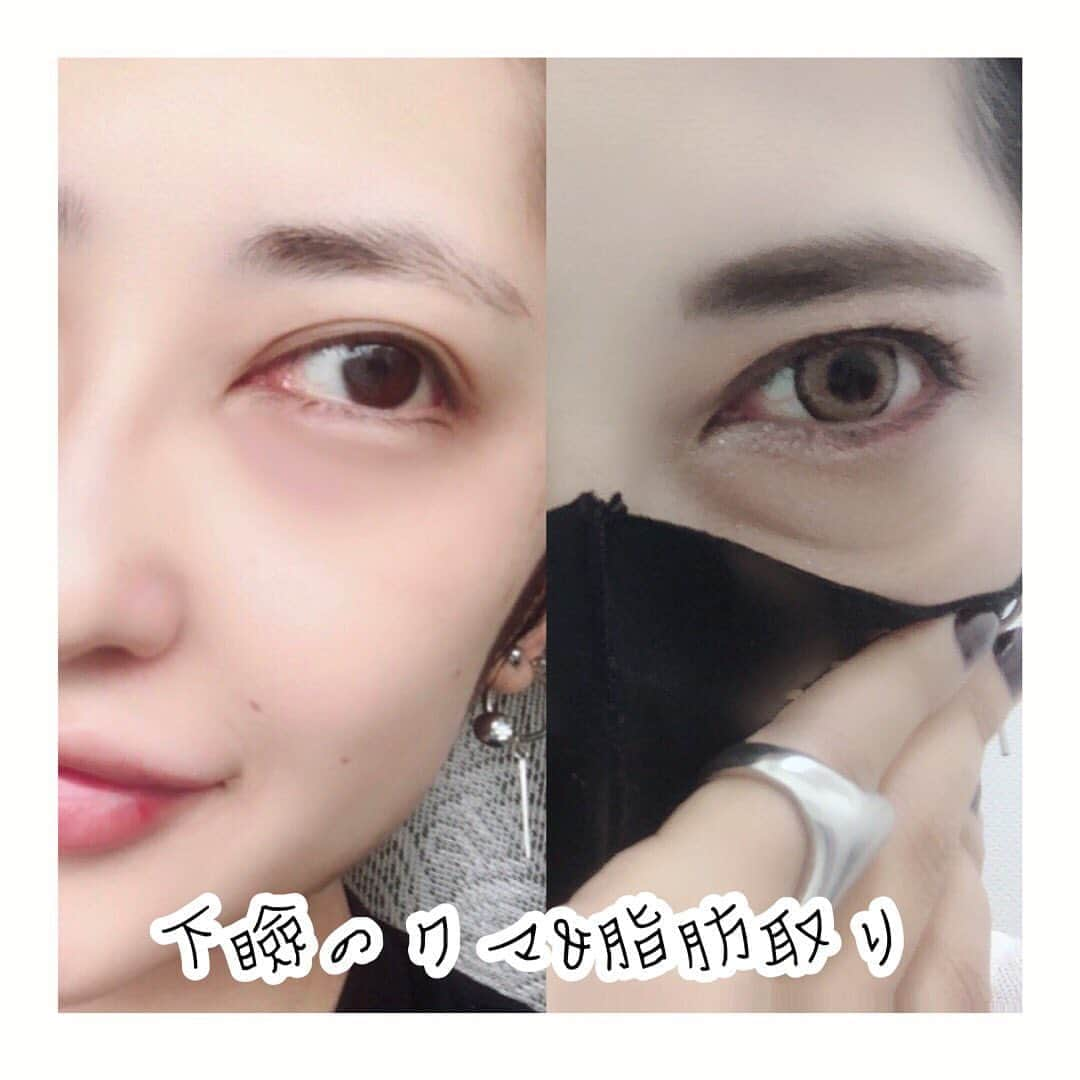 ゆりあさんのインスタグラム写真 - (ゆりあInstagram)「. . . . 下瞼のクマ&脂肪取り。 . . . 見た目の変化はこんなにも♫ 目の下たるんでると 老け顔が一気に増しますね。 老婆のようです.... . . . 同じアプリを使って撮影しましたが、 右は隠しきれてませんねw 左はまだアザがあるけど たるみよりいいっしょwww . . . . カラコンに目を向けてもらおうと カラコンもしてアイメイクもガッツリ。 コンシーラー塗りまくって 重ねて重ねて隠しても 隠せない目の下の岸部一徳。←え この前のポストに 一徳さん載せたから見てねww . . . . もっと前からやれば良かった。。 . . . 確かに整形ってさ 失敗もあるし、 まあこの失敗っていうのは だいたいが『思ってたんと違う』 って意味なんですけどねw . . . 思い立って行く人もいれば 私みたいに長年悩んで やっと行く人もいます♡ . . . 私はこの一年で すごく、ん~まあよく言えば 人が変わりました笑 . . . 我慢しない。 やりたいことはやる。 私は私。 私だけの人生。 一度きりしかない。 来世なんて生きてる奴の幻想だ。 . . . あー、あとアンチは 私の最高の酒のツマミですw ありがとう🥺w . . . 何でも挑戦して 失敗や後悔はすればいい。 大成功するかもしれないのに 諦めるのは勿体ないですよね♡ . . . 仕方なく手放して 諦めたことがたくさんあったんです。 だからこそ私はもう二度と 時間を無駄にしたくないんですw . . あっ、また脱線しましたねw . . . 高級なアイクリームも鍼治療も エステもマッサージも ありとあらゆることやったけど 無理だったから、やりました♡ . . . 結果、やって良かったです♡ . . . メイクの時間も減ったし マスクがずれて 慌てることもなくなったし←えw . . . １日目から冷やして 目薬して、化膿止め飲んで 3~4日目になって少しアザが 広がってきたけど 1週間くらいで落ち着くはずなので 経過載せますね♡ . . . . 私はこういうの隠さないので ほら、隠したって 分かる人には分かるんでw . . 聞きたいことあれば 聞いてください♡  . . . 안녕~♡♡ . . #まぶたの脂肪取り #脂肪取り #クマ取り #美容整形 #プチ整形 #美容外科 #シミ #シワ #目の下のクマ #目の下のたるみ #アンチエイジング #若返り #ヒアルロン酸 #ボトックス #미용성형  #성형외과 #수술 #눈밑지방재배치 #눈밑지방제거  #입술필러 #애교 #팔자주름 #입술 #입꼬리  #지방흡입 #피부늘어짐 #안티에이징 #미백  #綺麗は作れる #努力は必ず報われる . . . . 個人の体験、感想、意見なので 参考程度にどうぞ♡ . . . .」9月1日 10時32分 - yuria_life