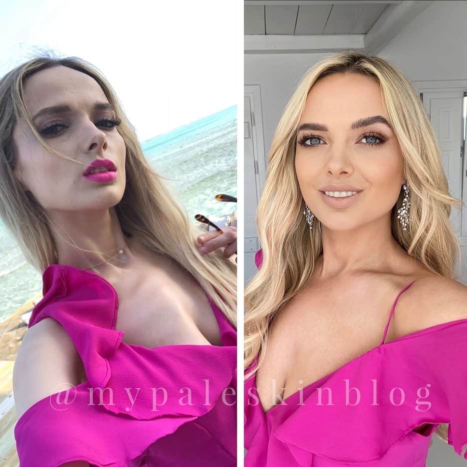 のインスタグラム：「You glow differently when you’re actually happy ✨💛✨ ⠀ ⠀ Happy #transformationTuesday everyone 💛. Here’s a lil before and after. ⠀ 20ish lbs heavier. infinitely healthier. Immeasurably happier. ⠀ Every time I find myself freaking out about being healthier and the size of my clothes, I remind myself that I used to fit into the same size as a 6-7 year old boy... and that’s not ok, normal or healthy. ⠀ Taking things one day at a time, but I’m only gon’ get badder ✨ 😏✨ ⠀ ⠀ #transformarion #recovery #transformation #weightgain #beforeandafter #mypaleskinblog #weightgainjourney ⠀ ⠀ ⠀」