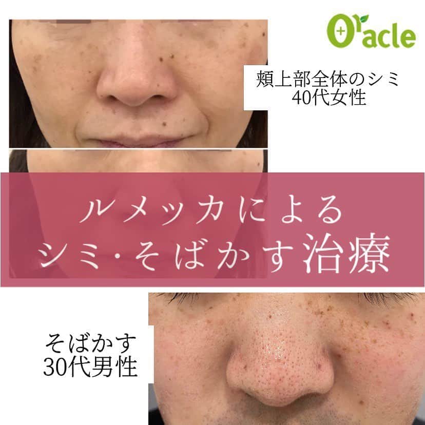 オラクル美容皮膚科東京新宿院さんのインスタグラム写真 - (オラクル美容皮膚科東京新宿院Instagram)「ルメッカによるシミそばかす治療﻿ ﻿ 肝斑がある方はルメッカは適応外となります。﻿ その場合はトーニングでまず肝斑の治療からスタートします。﻿ ﻿ ✍️女性の症例→光老化によるシミ。紫外線による頬全体のシミ﻿ ルメッカの反応がとてもよく、3回でほぼ綺麗になっています。ルメッカに併用してハイドラフェイシャルやコラーゲンピールでケア。﻿ ﻿ ✍️男性の症例→生まれつきのそばかす、紫外線によるシミ。かなり反応がよく、1回でかなり改善。﻿ ﻿ ﻿ 【ご予約について】﻿ ルメッカ人気のため9月のご予約も埋まってきております🙇‍♀️﻿ 9月以降シミ治療を開始したいとお考えの方はお早めにご相談ください。﻿ ﻿ 【YouTube】﻿ ルメッカの治療に密着した動画をYouTubeで配信しております。﻿ ぜひ参考にしてみてください😊﻿ ﻿ YouTubeで検索🔎オラクル美容皮膚科﻿ ﻿ ୨୧┈┈┈┈┈┈┈┈┈┈┈┈┈┈┈┈┈୨୧﻿ ﻿ ルメッカとは…﻿ シミ、そばかす、赤ら顔改善に適した﻿ フォトフェイシャル（IPL）です。﻿ ﻿ ルメッカは1回あたりの治療効果が高く、従来のフォトフェイシャルでは反応しないシミにも効果が期待できるようになりました。﻿ ﻿ よって少ない回数でシミが改善できるのが特徴です。﻿ ﻿ ﻿ ୨୧┈┈┈┈┈┈┈┈┈┈┈┈┈┈┈┈┈୨୧﻿ ﻿ 【ルメッカ料金】﻿ ☑️トライアル　顔全体　25,000円（税抜）﻿ ☑️通常　顔全体　30,000円（税抜）﻿ ﻿ ୨୧┈┈┈┈┈┈┈┈┈┈┈┈┈┈┈┈┈୨୧﻿ ﻿ ⚠️リスク　⏰ダウンタイム﻿ ﻿ 麻酔なしの施術　ゴムで弾かれたような痛み程度﻿ ほてりや赤みが出た場合も数時間でおさまります。﻿ 薄い瘡蓋程度が1週間（メイク可能）﻿ テープ保護は不要﻿ ﻿ ﻿ ୨୧┈┈┈┈┈┈┈┈┈┈┈┈┈┈┈┈┈୨୧ ﻿ ﻿ 🇯🇵オラクル美容皮膚科🇰🇷﻿ 📍東京新宿院﻿ 新宿3丁目19-4 MLJ新宿8階﻿ ﻿ 📍名古屋院﻿ 名古屋市中区錦3丁目24−4 サンシャイン栄5階﻿ ﻿ 【専門】﻿ ニキビ（跡）／毛穴／シミ／しわ／たるみ／痩身／アンチエイジング／美白美肌治療全般／ブライダル相談／メンズ美容﻿ ﻿ 🗝完全予約制﻿ 👠土日祝日も診療﻿ ﻿ 【予約方法】﻿ ☎0120-905-696﻿ ⏰9:00～21:00［年中無休］﻿ ﻿ LINE、メール24時間📧﻿ LINE🆔 @oracle.jp ﻿ 📩HPメールフォームよりお願いいたします﻿ ﻿ #オラクル美容皮膚科  #シミ #肝斑 #そばかす #シミ取り #シミケア #シミ対策 #美肌 #美肌ケア #美肌作り #赤ら顔改善　#メンズ美容　#美白効果 #トーンアップ  #美容皮膚科 #美容 #美容好き #美容部 #美容好きな人と繋がりたい #美容好き #韓国美容 #韓国 #美容オタク　#ルメッカ　#ピコレーザー　#ピコトーニング」9月2日 9時29分 - oraclejp