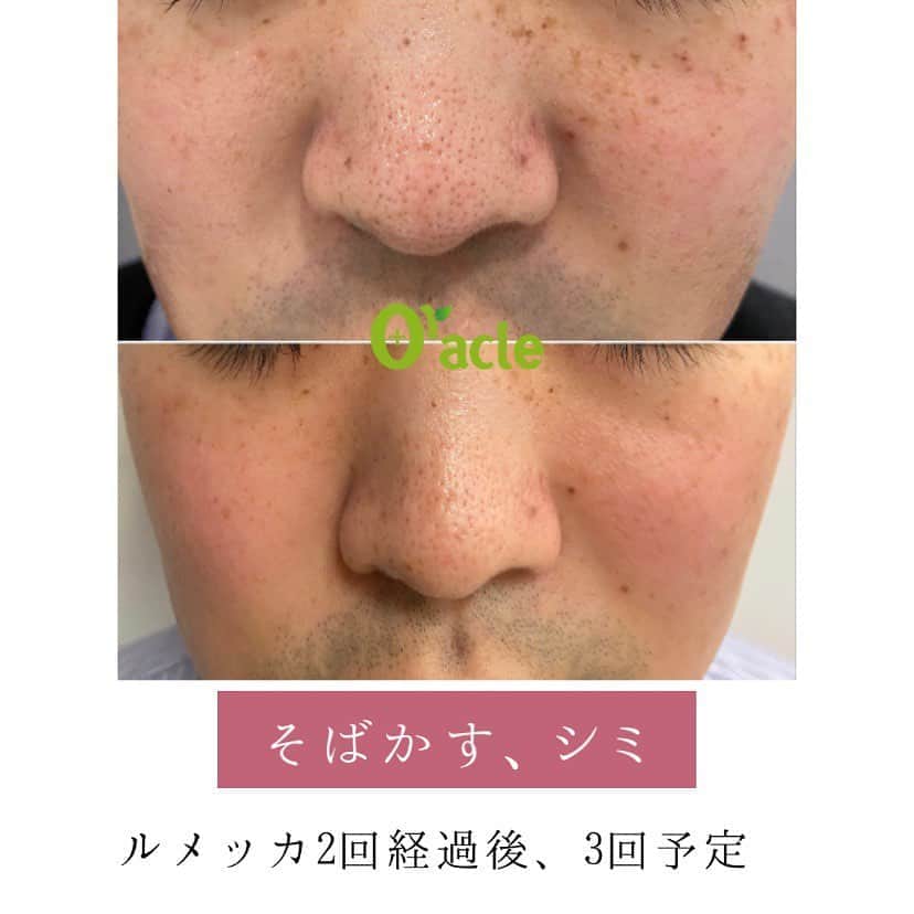 オラクル美容皮膚科東京新宿院さんのインスタグラム写真 - (オラクル美容皮膚科東京新宿院Instagram)「ルメッカによるシミそばかす治療﻿ ﻿ 肝斑がある方はルメッカは適応外となります。﻿ その場合はトーニングでまず肝斑の治療からスタートします。﻿ ﻿ ✍️女性の症例→光老化によるシミ。紫外線による頬全体のシミ﻿ ルメッカの反応がとてもよく、3回でほぼ綺麗になっています。ルメッカに併用してハイドラフェイシャルやコラーゲンピールでケア。﻿ ﻿ ✍️男性の症例→生まれつきのそばかす、紫外線によるシミ。かなり反応がよく、1回でかなり改善。﻿ ﻿ ﻿ 【ご予約について】﻿ ルメッカ人気のため9月のご予約も埋まってきております🙇‍♀️﻿ 9月以降シミ治療を開始したいとお考えの方はお早めにご相談ください。﻿ ﻿ 【YouTube】﻿ ルメッカの治療に密着した動画をYouTubeで配信しております。﻿ ぜひ参考にしてみてください😊﻿ ﻿ YouTubeで検索🔎オラクル美容皮膚科﻿ ﻿ ୨୧┈┈┈┈┈┈┈┈┈┈┈┈┈┈┈┈┈୨୧﻿ ﻿ ルメッカとは…﻿ シミ、そばかす、赤ら顔改善に適した﻿ フォトフェイシャル（IPL）です。﻿ ﻿ ルメッカは1回あたりの治療効果が高く、従来のフォトフェイシャルでは反応しないシミにも効果が期待できるようになりました。﻿ ﻿ よって少ない回数でシミが改善できるのが特徴です。﻿ ﻿ ﻿ ୨୧┈┈┈┈┈┈┈┈┈┈┈┈┈┈┈┈┈୨୧﻿ ﻿ 【ルメッカ料金】﻿ ☑️トライアル　顔全体　25,000円（税抜）﻿ ☑️通常　顔全体　30,000円（税抜）﻿ ﻿ ୨୧┈┈┈┈┈┈┈┈┈┈┈┈┈┈┈┈┈୨୧﻿ ﻿ ⚠️リスク　⏰ダウンタイム﻿ ﻿ 麻酔なしの施術　ゴムで弾かれたような痛み程度﻿ ほてりや赤みが出た場合も数時間でおさまります。﻿ 薄い瘡蓋程度が1週間（メイク可能）﻿ テープ保護は不要﻿ ﻿ ﻿ ୨୧┈┈┈┈┈┈┈┈┈┈┈┈┈┈┈┈┈୨୧ ﻿ ﻿ 🇯🇵オラクル美容皮膚科🇰🇷﻿ 📍東京新宿院﻿ 新宿3丁目19-4 MLJ新宿8階﻿ ﻿ 📍名古屋院﻿ 名古屋市中区錦3丁目24−4 サンシャイン栄5階﻿ ﻿ 【専門】﻿ ニキビ（跡）／毛穴／シミ／しわ／たるみ／痩身／アンチエイジング／美白美肌治療全般／ブライダル相談／メンズ美容﻿ ﻿ 🗝完全予約制﻿ 👠土日祝日も診療﻿ ﻿ 【予約方法】﻿ ☎0120-905-696﻿ ⏰9:00～21:00［年中無休］﻿ ﻿ LINE、メール24時間📧﻿ LINE🆔 @oracle.jp ﻿ 📩HPメールフォームよりお願いいたします﻿ ﻿ #オラクル美容皮膚科  #シミ #肝斑 #そばかす #シミ取り #シミケア #シミ対策 #美肌 #美肌ケア #美肌作り #赤ら顔改善　#メンズ美容　#美白効果 #トーンアップ  #美容皮膚科 #美容 #美容好き #美容部 #美容好きな人と繋がりたい #美容好き #韓国美容 #韓国 #美容オタク　#ルメッカ　#ピコレーザー　#ピコトーニング」9月2日 9時29分 - oraclejp
