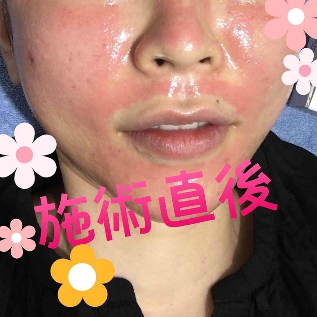 東京美容外科公式さんのインスタグラム写真 - (東京美容外科公式Instagram)「こんにちは😃銀座院です✨  本日ご紹介はヴェルベットスキン✨ ダーマペン✖️コラーゲンピール ダーマペンは1秒間で120回もの振動を行うことで皮膚に小さな穴をあけることができます。その数は1秒間でおよそ1,920個。これによりダーマペン4の施術後にマッサージピーリングを使用することでお肌にマッサージピーリングの薬剤がより浸透していきます。  施術前に麻酔クリームを塗るので、痛みは感じません。（個人差があります(^^)）  こんな方にオススメ✨✨ ♦️ニキビ&ニキビ跡 ♦️毛穴の開きやくすみが気になってきた ♦️シワ&たるみが気になる  一回の治療でも、効果が目に見えて分かる✨✨ 個人差はありますが、何回か続けて頂くことで、肌質の改善へと繋がります♡  気になる方は是非、お問い合わせ下さい(^^) カウンセリングは随時受付しております♪  ==🎁お問い合わせはこちら🎁==== 詳しくはプロフィールのURLから公式サイトへ♪ ▼フリーダイヤル 0120-658-958 （コールセンター受付時間：9：00～21：00） ▼LINE予約 @tkc110  #東京美容外科#ヴェルベット#ダーマペン#ニキビ跡#クレーター #コラーゲンピール#肌質改善#美肌#キレイになりたい#大人気#美容#美容外科#美魔女#気持ち良い#ごわつき」9月2日 11時46分 - tokyobiyougeka_jimukyoku