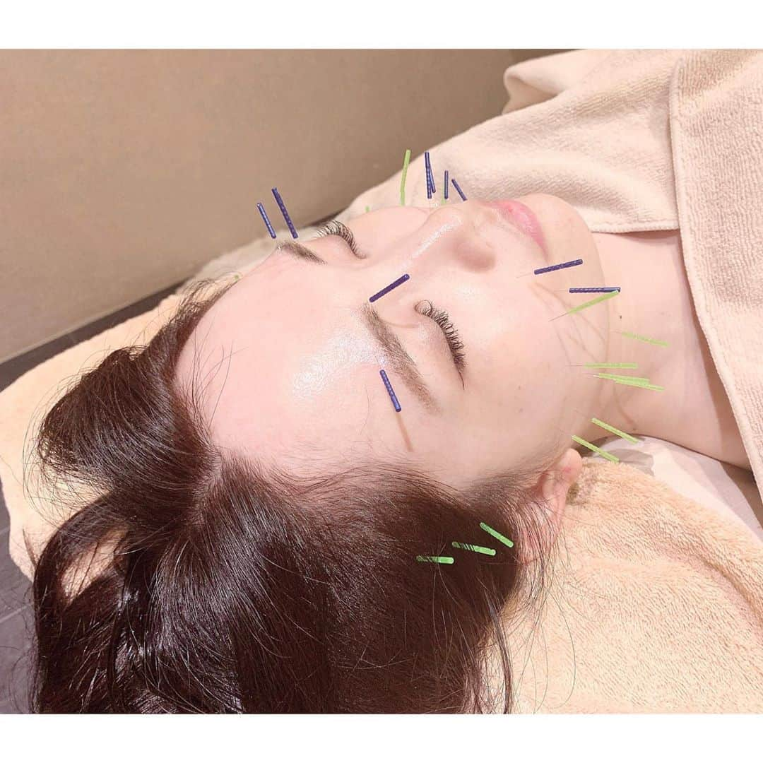 浅井麻里さんのインスタグラム写真 - (浅井麻里Instagram)「💆‍♀️✨﻿ ﻿ 先日ウェディングモデルのお仕事に備えて﻿ 美容鍼に行ってきた♬﻿ ﻿ 2枚目の写真は顔に美容鍼刺さってるので﻿ スライドしてびっくりしないように注意❣️🤣﻿ ﻿ 代々木上原の鍼灸サロン【ラ・コンシェル】で﻿ 小顔リフトアップ美鍼＋﻿ フェイシャルトリートメントコース✨﻿ @laconcier_yoyogiuehara﻿ ﻿ 鍼は場所によって、刺す瞬間だけ﻿ チクッとかジーンとか感じるところもあるけど、﻿ 刺さってる時には違和感や痛みないから﻿ 思わずうとうとしちゃうくらい😪（笑）﻿ わたしは目の疲れとかフェイスラインが﻿ 気になってたからそこを重点的に💫﻿ ﻿ 終わった後は、目ぱっちり！すっきり！✨👀﻿ 輪郭きゅっと引き締まったし、﻿ 肌もハリが出て嬉しい💕☺️﻿ ﻿ 続けるとだいぶ変わってくるみたいだから﻿ またやりたいな♬♬﻿ ﻿ ﻿ #小顔リフトアップ美鍼#代々木上原#ラコンシェル#美容鍼#美容#鍼#pr#facecare」9月2日 19時31分 - mari_asai_625