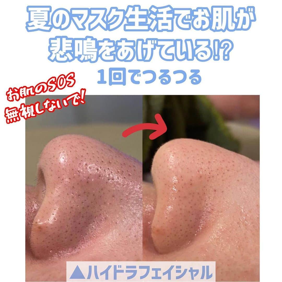 オラクル美容皮膚科東京新宿院さんのインスタグラム写真 オラクル美容皮膚科東京新宿院instagram 1回で毛穴の汚れを徹底洗浄 ハイドラフェイシャルで余分な皮脂や角質を取り除きます 夏のマスク生活でお肌も悲鳴をあげているかも お肌のざらつき