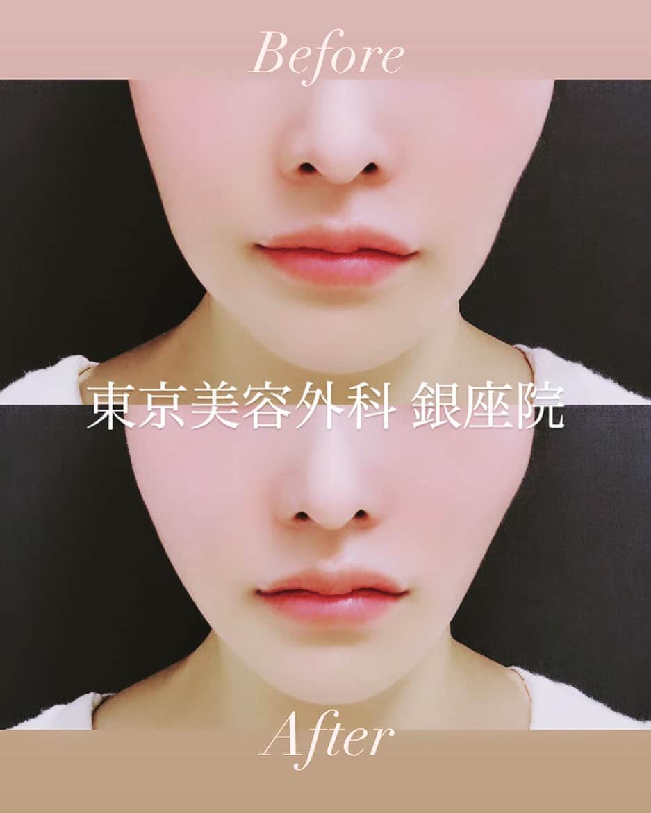 東京美容外科公式さんのインスタグラム写真 - (東京美容外科公式Instagram)「東京美容外科銀座院です  今回はミントリフトについて ご説明いたします✨  ミントリフトⅡWinkは360度にらせん状のコグ（トゲ）がついた特殊な糸でリフトアップを行います。  ミントリフトⅡWinkは物理的に皮膚を持ち上げる効果もありますが、糸が継続的に肌を刺激します。 すると糸の周りではコラーゲンやエラスチンが増殖するので、内側からハリがアップし、若々しい肌へと導きます。  引き上げと共に若々しいお肌を 手に入れたい方、 1日で効果を感じられたい方  ぜひお試し下さい🙆‍♀️✨  ====🎁お問い合わせはこちら🎁==== 詳しくはプロフィールのURLから公式サイトへ♪ ▼フリーダイヤル 0120-658-958 （コールセンター受付時間：9：00～21：00） ▼LINE予約 @ tkc110 ========================= #東京美容外科 #銀座院#東京美容外科銀座院 #東美 #美容外科 #整形 #手術 #スタッフ#スタッフ施術#スタッフから人気#シワ#アンチエイジング#老け顔#たるみ#加齢#糸#ミントリフト#ミント#リフトアップ#若返り#モニター #美容 #美容施術 #美容整形 #美容女子 #整形」9月4日 21時14分 - tokyobiyougeka_jimukyoku