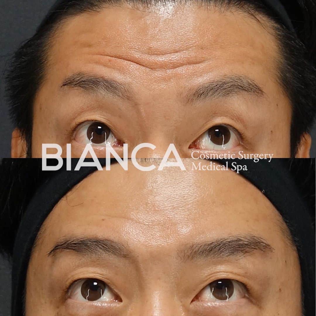 のインスタグラム：「【Natural Botox Method🌿💉】﻿ ﻿ 全くシワが無いのは不自然かつ、ボトックスで全てのシワを無くそうとすると表情が固くなることがあります。﻿ だからこそ、ナチュラルなシワ治療を心がけています。﻿ ﻿ ✔︎特に額はかなりテクニックが必要な場所。﻿ 打ち過ぎると目周りが重たくなってしまったり、頭痛のような感覚が続いてしまったりと不具合が起きやすいのです。﻿ ﻿ こちらのモニターさんは、最適な量を最適な場所に注入したことにより、表情が重たくなることなく自然な若返りが実現しました☺️👍﻿ ﻿ ボトックスは手軽な治療である一方、医師の正しい診断と治療が大事です👩‍⚕️✨﻿ ﻿ ご検討中の方、是非一度カウンセリングに﻿ お越しください😘﻿ ﻿ ﻿ 🌸額ボトックス﻿ 💉Botox Vista 8単位﻿ ﻿ 💴製剤料 600円/単位﻿ 別途 ボトックス施術料 20,000円﻿ ⏳治療時間: 5分﻿ 🗓持続期間: 4〜6ヶ月﻿ 😷腫れ・内出血: 数日程度﻿ ﻿ ⚠️ご予約の際は﻿ 『Dr Yuu（辻沢）のインスタ見た』の一言をお願いします👩‍⚕️✨﻿ ﻿ 📍BIANCA CLINIC﻿ ✔︎表参道院﻿ 03-6433-5994﻿ 東京都港区南青山5-11-10  南青山511ビル 2F﻿ ✔︎銀座院﻿ 03-6263-2690 ﻿ 東京都中央区銀座1-5-6 銀座レンガ通り福神ビル 4F﻿ 診療時間 10:00〜19:00﻿ 年中無休（年末年始を除く）﻿ 🔜﻿ ﻿ #美容好き#プチ整形#美魔女#美容好きな人と繋がりたい#美容垢#綺麗になりたい #美容皮膚科 #美容外科 #cosmeticsurgery #plasticsurgery #biancaclinic #ビアンカクリニック #プレ花嫁さんと繋がりたい #followｍe #フォローミー #銀座 #女医 #モニター募集  #dryuuボト﻿ #若返り #眉間ボトックス #ダイエット #額ボトックス #プチ整形  #イメージチェンジ #ボトックス #目尻ボトックス #女医 #額ヒアルロン酸 #バニーラインボトックス」