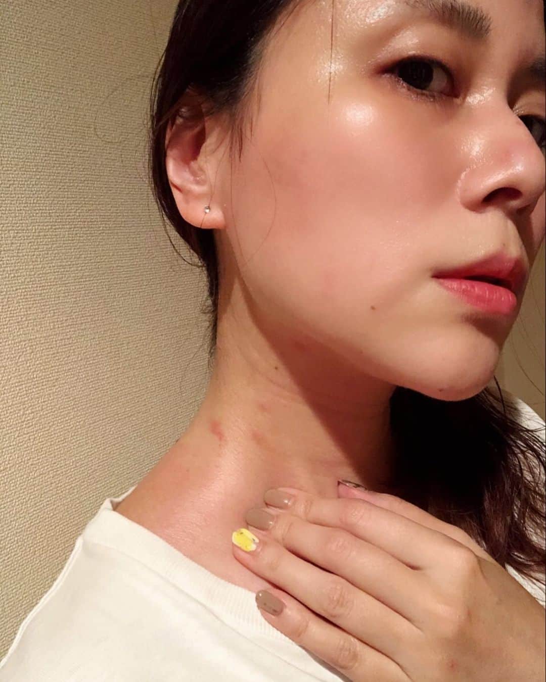 のインスタグラム：「なんだか際どい処に吹き出物が...( ･᷄ὢ･᷅ ) 湿疹？汗負け？ちょっと痒い。 普段ほとんど肌荒れしないんだけど。 マスクと冷房のせいか、頬も荒れ気味。 清潔に保って化粧水保湿で乗り切れるか。 #肌荒れ #湿疹」