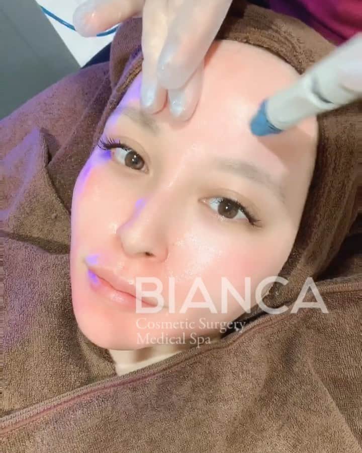 のインスタグラム：「【久しぶりのHydrafacial💕】﻿ ﻿ 二枚目は取れた汚れと角栓😨💦﻿ ここまで取れると本当にスッキリします🥺💖﻿ ﻿ BIANCAはHydrafacial症例数日本一🏆🥇🗻✨﻿ ﻿ 特許取得の技術である🌪水流🌪の力を利用してお肌に美容成分を補給しながら、その美容成分を含んだ水流で汚れを排出することによって、余分な皮脂や角質の除去と同時にクレンジングや保湿を行うことができます♻️✨﻿ ﻿ ⚠️最近は"ハイドラ〜"という模造品が多く出回っているのでお気をつけ下さい。﻿ 効果も全く違いますので、ご注意ください🥺﻿ ﻿ ☑️HydraFacial MD﻿ ♻️毛穴の汚れ・角質除去・肌質改善﻿ 💴 19,800円 / 回﻿ 💉麻酔: なし﻿ 😷DT: なし﻿ ﻿ ⚠️ご予約の際は﻿ 『Dr Yuu（辻沢）のインスタ見た』の一言をお願いします👩‍⚕️✨﻿ ﻿ 📍BIANCA CLINIC﻿ ✔︎銀座院﻿ 03-6263-2690 ﻿ 東京都中央区銀座1-5-6 銀座レンガ通り福神ビル 4F﻿ 診療時間 10:00～19:00﻿ 年中無休（年末年始を除く）﻿ ﻿ 9月勤務日🎑﻿ 表参道院﻿ ↪︎1 3 6 14 16 19 21 24 27 30﻿ 銀座院﻿ ↪︎2 5 17 18 20 22 25 26﻿ ﻿ #bianca #plasticsurgery #cosmeticsurgery #beauty #美容外科 #美容皮膚科 #美容整形 #プチ整形 #美肌 #美魔女 #美容 #アンチエイジング #ビューティー #hydrafacial #ハイドラフェイシャル #ピーリング #スキンケア #毛穴 #毛穴ケア #毛穴レス #biancaclinic #ビアンカクリニック」