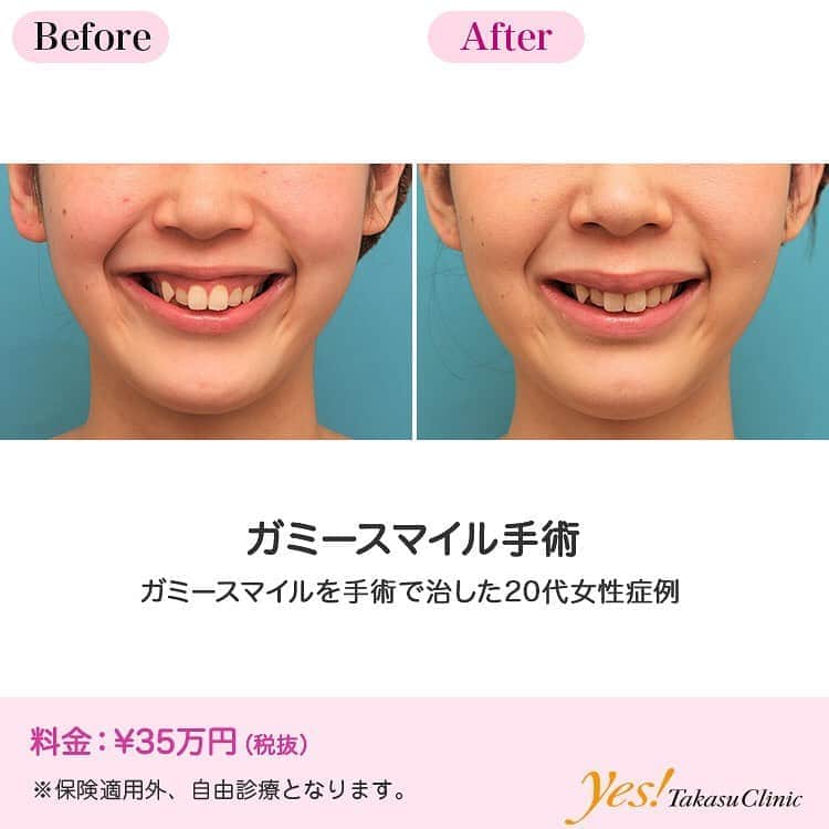 高須クリニックのインスタグラム：「👨🏻‍⚕️高須幹弥医師からのコメント✨⠀ 20代女性の患者様で、ガミースマイルを改善したいというご要望でした。 診察させていただいたところ、骨格的にやや上顎が縦に長く、且つ、前方に突出しており、それによって笑ったときに歯茎がかなり見えるようになっていました。 患者様は、LefortⅠ骨切りなどの大掛かりな手術は希望しておらず、また、ボトックス注射などの一時的な効果の治療も望んでいなかったため、耳介軟骨移植でガミースマイル修正手術をすることになりました。  手術は、片側の耳甲介軟骨を採取し、鼻の穴の中の切開から上口唇に移植しました。 手術後は、笑っても歯茎の見える面積がかなり小さくなり、ガミースマイルは改善しました。 ---------------------------------------------------- 🌈料金✨⠀ ●ガミースマイル手術 ¥350,000【東京、横浜、名古屋、大阪】 ---------------------------------------------------- ⚠️リスク・副作用・合併症✨⠀ ●ガミースマイル手術 移植した軟骨が触れる 思いっきり笑えば多少歯茎が見える 感染 --------------------------------------------------- 😊施術についての詳細✨⠀⠀ https://www.takasu.co.jp/photo/gammy004.html ---------------------------------------------------- 📞ご予約・お問い合わせ✨⠀ 0120-5587-10⠀ https://www.takasu.co.jp/cgi-bin/form/contact.cgi ※症例写真や施術に関するご質問なども上記までお願い致します。 ---------------------------------------------------- #ガミースマイル #ガミースマイル手術 #ガミースマイル改善 #耳介軟骨移植  #皮膚 #美容 #美肌 #エイジングケア #美容整形 #美容外科 #美容クリニック #美容好き #美容皮膚科 #モニター #モニター募集 #高須クリニック #高須クリニック名古屋 #高須幹弥 #整形したい #プチ整形 #症例 #症例写真 #可愛くなりたい #可愛い #美人」