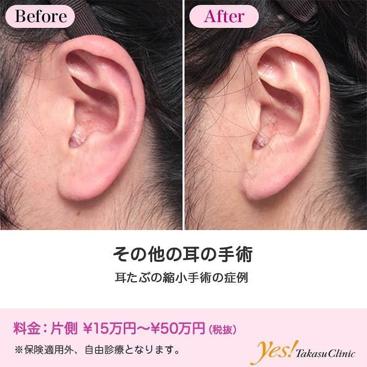 高須クリニックのインスタグラム：「👨🏻‍⚕️高須幹弥医師からのコメント✨⠀ 耳たぶが大きく、ぶら下がっているのが悩みの男性患者様でした。 確かに、平均サイズよりやや大きめで、大仏様のように見え、ご本人様は本気で悩んでらしたので、手術で耳たぶを縮小することになりました。 手術は、両側の耳たぶを、傷跡が目立たないように耳の付け根で切開し、余分なたるみを切開して、縫合しました。 術後は、耳たぶが平均サイズくらいになり、シャープな顔立ちになりました。 耳の形で真剣に悩んでいる方は多く(特に男性に多いです)、当院では、可能な限り、ご本人様の納得の行く耳になるように手術させていただいております。 ちなみに、福耳にするために耳たぶを大きくする場合はヒアルロン酸を注射します。 ---------------------------------------------------- 🌈料金✨⠀ ●その他の耳の手術 片側 ¥150,000~500,000【東京、横浜、名古屋、大阪】 ---------------------------------------------------- ⚠️リスク・副作用・合併症✨⠀ ●その他の耳の手術 手術後に処方する抗生剤や痛みどめによるアレルギー症状 仕上がりのわずかな左右差（完璧なシンメトリーは不可） --------------------------------------------------- 😊施術についての詳細✨⠀⠀ https://www.takasu.co.jp/photo/mimiother06.html ---------------------------------------------------- 📞ご予約・お問い合わせ✨⠀ 0120-5587-10⠀ https://www.takasu.co.jp/cgi-bin/form/contact.cgi ※症例写真や施術に関するご質問なども上記までお願い致します。 ---------------------------------------------------- #耳たぶの縮小手術 #耳たぶ縮小 #耳たぶを小さくしたい #耳の手術 #耳整形 #皮膚 #美容 #美肌 #エイジングケア #美容整形 #美容外科 #美容クリニック #美容好き #美容皮膚科 #モニター #モニター募集 #高須クリニック #高須クリニック名古屋 #高須幹弥 #整形したい #プチ整形 #症例 #症例写真 #可愛くなりたい #可愛い #美人」