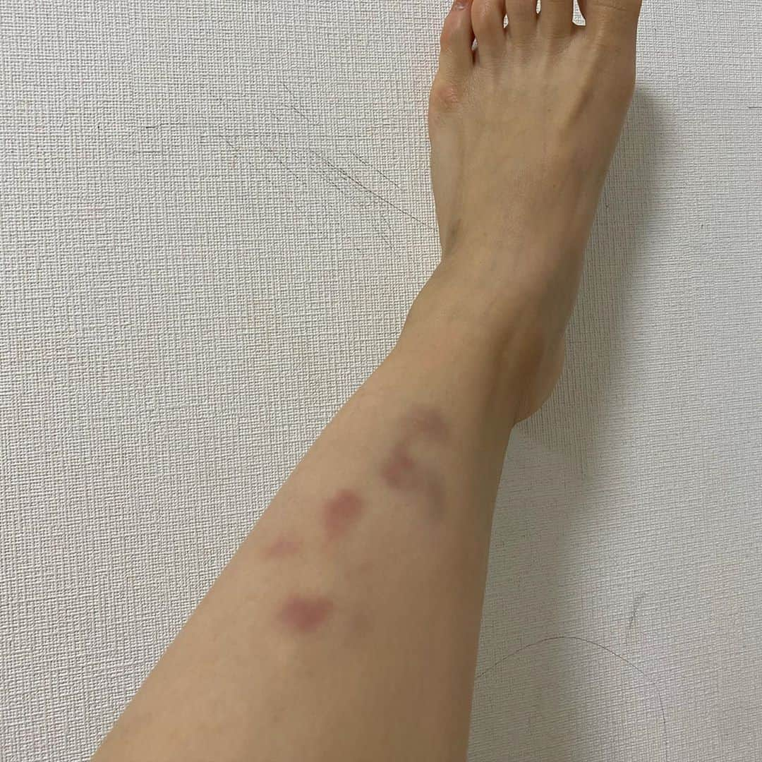 熊田曜子さんのインスタグラム写真 - (熊田曜子Instagram)「自粛生活で体重がプラス３キロ💦 @takemari1219 さんの 痩せると噂のダンスを踊ってみたよ🐷 いい汗かいたー💦  別のお仕事で ある事を10年ぶりくらいにやったら こんなあざになっちゃった😱 でも明日も頑張りたい💪  #体づくり　#YouTube #熊田曜子チャンネル　#アラフォー　#痩せるダンス　#竹脇まりな　さん　#お手本　#あざ　#足　#筋肉痛　#壁の落書き　#いつの間に」10月2日 20時16分 - kumadayoko