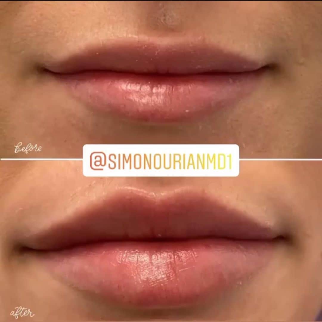Nicky Gileさんのインスタグラム写真 - (Nicky GileInstagram)「lip lock 💋🔒 thank you for always taking the best care @simonourianmd1 ✨ swipe to see my before & after results 😍 he is AMAZING! 💉」10月3日 5時37分 - nickygile