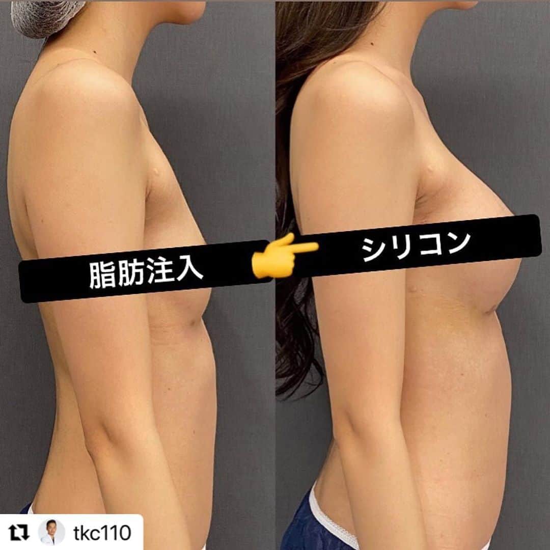 東京美容外科公式のインスタグラム：「#Repost @tkc110 with @make_repost ・・・ 脂肪注入豊胸やヒアルロン酸豊胸をした患者さんが、やっぱりシリコンによる豊胸したいと来院されることが多いです。 この方は他院で脂肪注入豊胸後に感染をおこしてしまい、その修正でした。 詳細は個人アカウント @doctorjumpeiono に投稿があります。 今週来週も毎日豊胸手術してます💦 #小野准平 #豊胸 #シリコン豊胸 #脂肪注入豊胸 #ヒアルロン酸豊胸 #デュアルプレーン豊胸 #ハイブリッド豊胸 #コンデンスリッチ豊胸 #バストアップ #育乳 #ナイトブラ #ビキニ #ボディメイク #くびれ作り #ダイエット #トレーニング #新宿 #歌舞伎町 #キャバクラ #キャバ嬢 #ホステス #モデル #ギャル #ダンサー #整形垢」