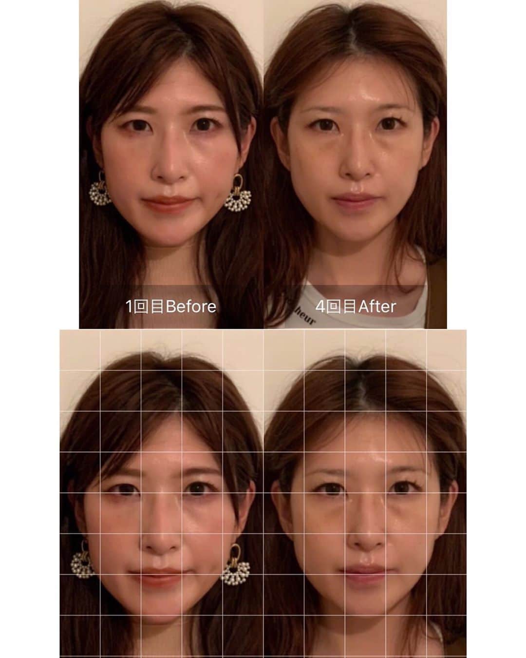 l.lily1013さんのインスタグラム写真 - (l.lily1013Instagram)「1ヶ月間、週1で『脳洗浄小顔調整』を @parafuse.kanagawa_erika さんの元、 でやり続けた結果をご報告。。。  結果は2、3、4枚目！！ 3回目からは段々顔の歪みが整ってきたようで、大きさも定着してきて、左右差も減った😳  5枚目6枚目の写真の4回目の施術はそこまで大きな変化はないけど、 顔の余白が明らかにちっちゃくなってますよね😳✨✨  この日はリラックスしまくって寝てしまいました🤣  念入りな頭皮マッサージとオイルマッサージで見違える違い😭✨✨ 頭のちっちゃさの違いは特に手で覆うとわかるので、 1回目より明らかちっちゃくなったなーって肌でわかるんですよね🥺✨  ご予約時に私の名前を出すと 2千円割引になるので、ぜひ1度 @parafuse.kanagawa_erika さんでこの感動を体験してみてください✨  ほんと顔がスッキリします😳  #小顔マッサージ #小顔矯正 #自律神経を整える #自律神経の乱れ #睡眠改善 #睡眠の質 #小顔 #エステサロン #歪み改善 #美容好きな人と繋がりたい #小顔エステ #小顔サロン #小顔になりたい #小顔調整 #小顔矯正サロン」10月5日 14時38分 - l.lily1013