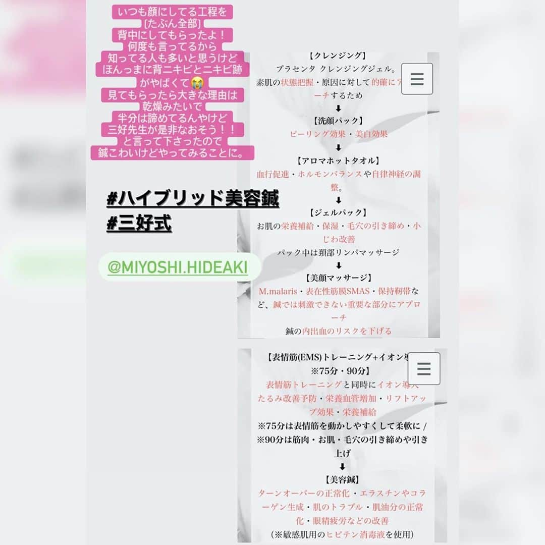 藤森マリナさんのインスタグラム写真 - (藤森マリナInstagram)「美背中活動🥺✨ #まりなはんの美活紹介コーナー * * ▶︎ @mouton_shinkyu 📍梅田(大阪院) ▶︎ @acupa.salon 📍恵比寿(東京院) * * 背中のしつこい色素沈着したニキビ跡を どうにかすべく 色んな施術試してるのですが まりなは美顔鍼して 自分の肌と鍼の相性がすごくいいの 知ってるし 何も使わずもとから治癒する鍼が すごくいいと思うから 背中にしてみたくて 相談したら 鍼治療とは別に ニキビ肌にアプローチする 工程を背中にしてもらえることに！！ * * 鍼はすぐにはよくならないから でもよくする力を引き出して ターンオーバーを早める効果があるから しっかり保湿して また来月もやってみることに🔥 * * それまで三好先生流 背中保湿をおうちで頑張ります‼️ 加工いらずの背中になる日を信じて 人任せばかりでなく もっと。もっと。 今以上に 毎日のお手入れがんばらなきゃ！✨ * * * #ハイブリッド美容鍼#美容鍼#鍼灸院 #美肌ケア#背中ニキビ#背中美人#ニキビケア#ニキビ跡 #プレ花嫁準備#花嫁美容」10月5日 23時38分 - maaarina0806