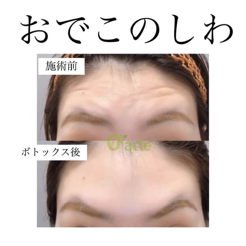 オラクル美容皮膚科東京新宿院さんのインスタグラム写真 - (オラクル美容皮膚科東京新宿院Instagram)「人気のシワボトックス‼️﻿ マスク生活も長くなってきましたね😷﻿ 顔の下部はマスクで隠している分﻿ 顔上、目の周りは特に強調され目立つため﻿ しわもマスク生活でのお肌のお悩みのひとつ👆﻿ ﻿ しわの解消にはボトックスがおすすめです。﻿ 即効性もあり、1回で効果が期待できます。﻿ ﻿ 施術はたったの5分程度。﻿ 約半年に1度の治療でOK🙆‍♀️﻿ 完成まで約5日ほどで効いてきます🎵﻿ ﻿ オラクルスタッフも定期的なボトックスはかかせません。﻿ ﻿ 当院は﻿ 韓国製のリジェノックス﻿ アメリカ製のアラガン　のボトックスを使用しております。﻿ 注入量の目安も参考にしてみてください。﻿ ﻿ 【ボトックス料金】税抜き﻿ （額以外の顔）﻿ リジェノックス　10単位	￥5,000﻿ アラガン 10単位	￥7,000﻿ ﻿ （額）﻿ リジェノックス　10単位	￥10,910﻿ アラガン 10単位　￥13,637﻿ ﻿ （肩・ふくらはぎ）﻿ リジェノックス 10単位　¥8,000﻿ アラガン 10単位　¥10,000﻿ ﻿ ※新宿院 古市院長指名の場合は指名料2200円がかかります。﻿ ﻿ ﻿ ▪️▫️▪️▫️▪️▫️▪️▫️▪️▫️﻿ ﻿ 🇯🇵オラクル美容皮膚科🇰🇷﻿ 📍東京新宿院﻿ 新宿3丁目19-4 MLJ新宿8階﻿ ﻿ 📍名古屋院﻿ 名古屋市中区錦3丁目24−4 サンシャイン栄5階﻿ ﻿ 【専門】﻿ ニキビ（跡）／毛穴／シミ／しわ／たるみ／痩身／アンチエイジング／美白美肌全般／ブライダル相談／メンズ美容﻿ ﻿ 🗝完全予約制﻿ 👠土日祝日も診療﻿ ﻿ 【予約方法】﻿ ☎0120-905-696﻿ ⏰9:00～21:00［年中無休］﻿ ﻿ LINE、メール24時間📧﻿ LINE🆔 @oracle.jp ﻿ 📩HPメールフォームよりお願いいたします﻿ ﻿ #ボトックス　#ボトックス注入　#ボトックス注射　#シワボトックス　#眉間のシワ　#しわ　#目尻のしわ　#しわボトックス　#アラガン　#おでこのしわ　﻿ #シワ改善 #シワ #シワ対策 #しわ改善 #美容皮膚科」9月12日 11時06分 - oraclejp