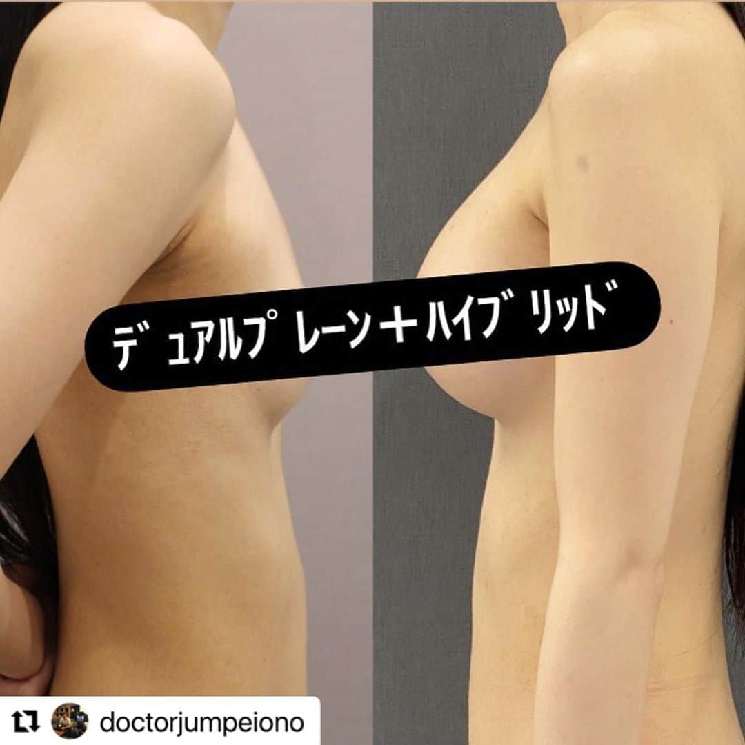 東京美容外科公式さんのインスタグラム写真 - (東京美容外科公式Instagram)「#Repost @doctorjumpeiono with @make_repost ・・・ 前回の投稿のビフォーアフターです。 デュアルプレーン法によるシリコンインプラント挿入と、脂肪注入を併用したハイブリッド法を行っています。 risk 一時的な乳房皮膚の知覚異常、一時的な切開部（ワキ）のひきつれなど、血腫、感染など 感染などの合併症のリスクは過去の治療歴で変わってきます。 昨年のデータでも、胸の初回手術の方（ワキなど切開部の手術含む）の感染はゼロ❗️です。 しかしアクアフィリング注入歴がある方は感染のリスクが上がります。 年間シリコン300例の豊富な蓄積データに基づいて、具体的なリスクをカウンセリングでは包み隠さずお伝えします。 #小野准平 #豊胸 #シリコン豊胸 #ハイブリッド豊胸 #デュアルプレーン豊胸 #バストアップ #脂肪注入豊胸 #脂肪吸引 #くびれ作り #ボディメイク #ダイエット」9月12日 20時16分 - tokyobiyougeka_jimukyoku