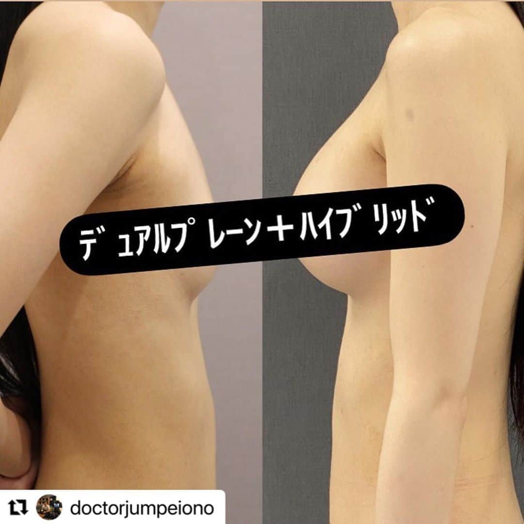 東京美容外科公式のインスタグラム：「#Repost @doctorjumpeiono with @make_repost ・・・ 前回の投稿のビフォーアフターです。 デュアルプレーン法によるシリコンインプラント挿入と、脂肪注入を併用したハイブリッド法を行っています。 risk 一時的な乳房皮膚の知覚異常、一時的な切開部（ワキ）のひきつれなど、血腫、感染など 感染などの合併症のリスクは過去の治療歴で変わってきます。 昨年のデータでも、胸の初回手術の方（ワキなど切開部の手術含む）の感染はゼロ❗️です。 しかしアクアフィリング注入歴がある方は感染のリスクが上がります。 年間シリコン300例の豊富な蓄積データに基づいて、具体的なリスクをカウンセリングでは包み隠さずお伝えします。 #小野准平 #豊胸 #シリコン豊胸 #ハイブリッド豊胸 #デュアルプレーン豊胸 #バストアップ #脂肪注入豊胸 #脂肪吸引 #くびれ作り #ボディメイク #ダイエット」