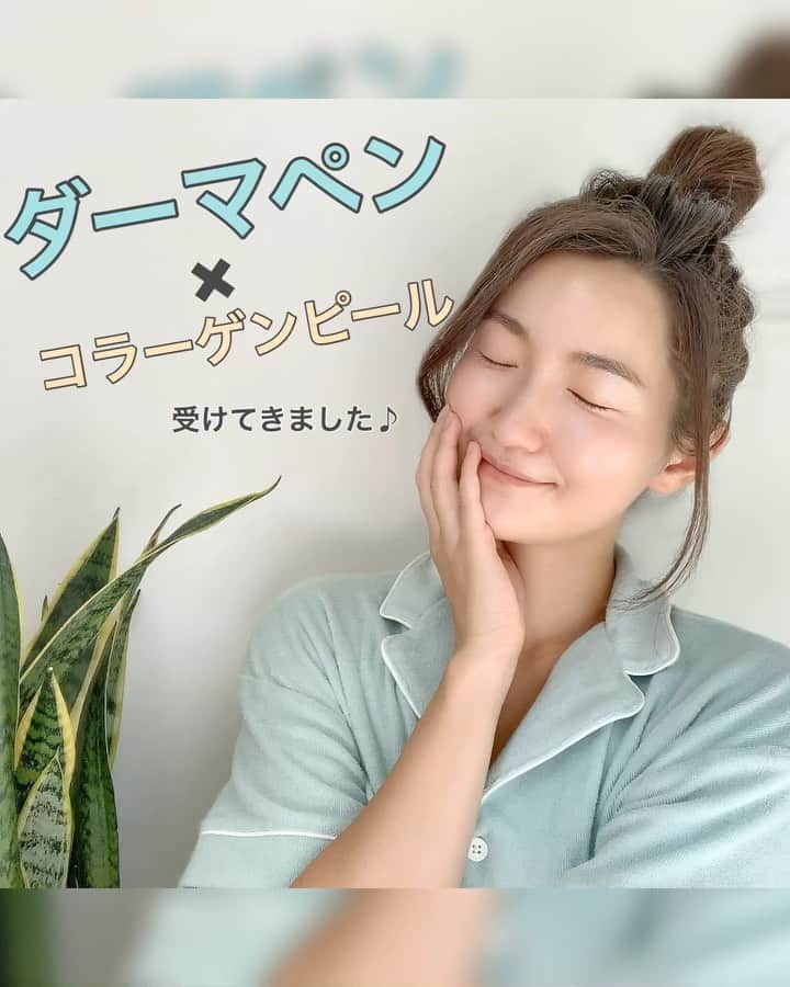 リナのインスタグラム：「@htc.the.beauty   近頃大人気の美容施術である、 #ヴェルベットスキン を受けてきました！ ヴェルベットスキンは、 ダーマペンとコラーゲンを併用する 美肌治療🌟  ダーマペンは、 肌に微細な針で穴を開けて、 自然治癒力によって、 コラーゲンの生成を刺激して、 皮膚を若返らせる治療法！  すでに数回、治療していますが、 毛穴の開きに効果を感じているので 大好きな施術❤️  ヴェルベットスキンは、 そのダーマペンに 美白効果やハリつや感が得られる コラーゲンピールを合わせたもの！  施術自体は、 麻酔クリームを塗って行うので、 針による強い痛みはないですよ♪  数日間、肌の赤みが残るので、 おやすみ前の日や マスクで隠れる目から下で受けるのがいいかもしれません♪  コラーゲンピールによる ハリツヤはよく朝から実感できましたよ🌟 洗顔後のまっさらな肌でも しっかりとツヤを確認できるほど❣️  術後3日もすれば、 メイクでキレイに隠せるくらいになります💄  やっぱりこの施術は、 大好きすぎて辞められない❤️  日比谷トータルクリニックの院長先生は とてもおキレイで安心して施術を受けられるので、 是非カウンセリングに行ってみてくださいね👩‍⚕️ @orchidpink1112  ...................................................... #日比谷トータルクリニック #ヴェルベットスキン　#ダーマペン #ダーマペン4 #コラーゲンピール #美肌治療 #美容医療 #美は1日にしてならず #美肌ケア #美肌メンテナンス #ハリツヤ」