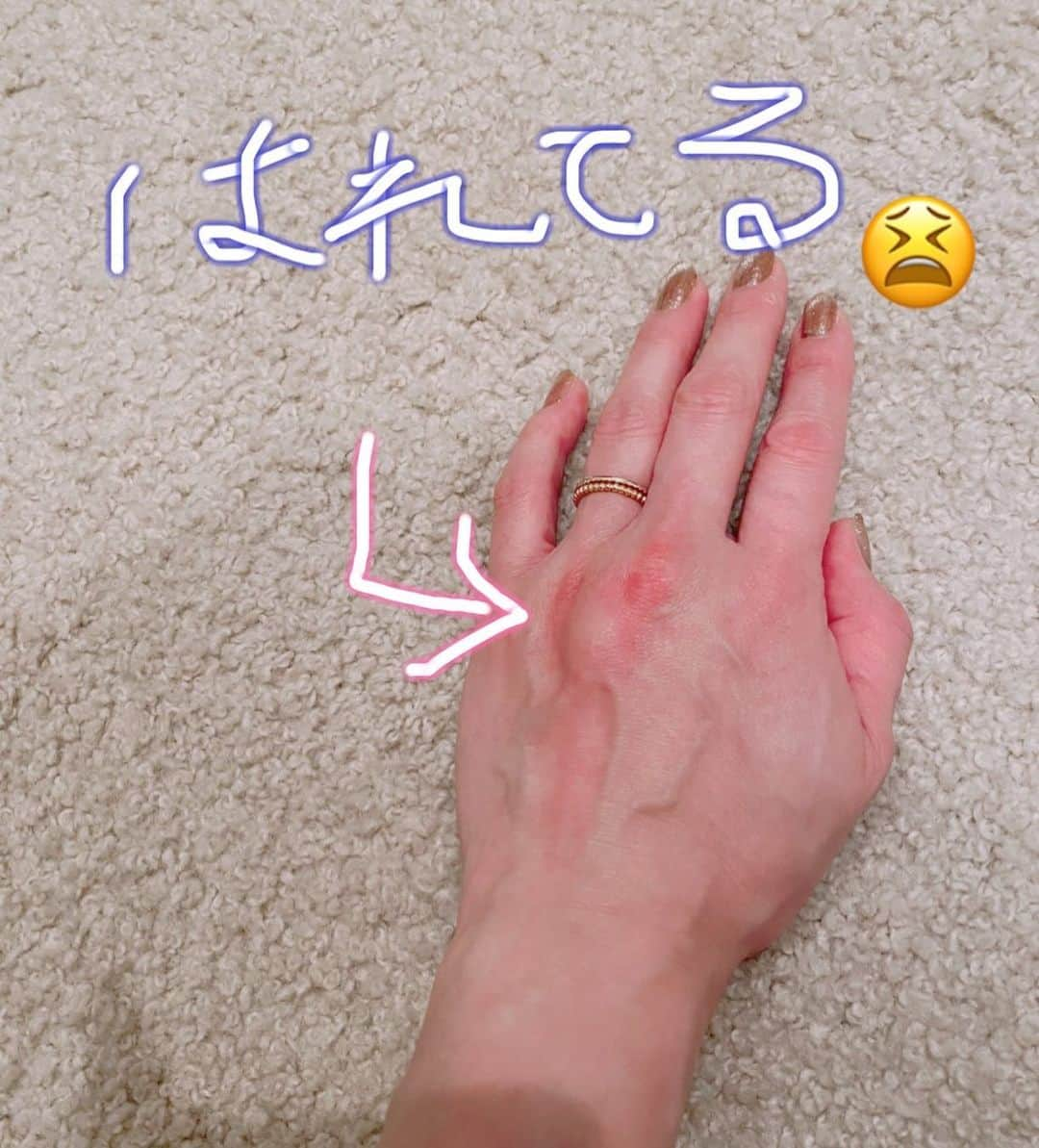 田中雅美さんのインスタグラム写真 - (田中雅美Instagram)「またやられた😭  ・ ・ ほんの数分の外出で😭  ・ ・ #虫刺され #腫れてる #かゆい」9月14日 19時58分 - tanakamasami_official