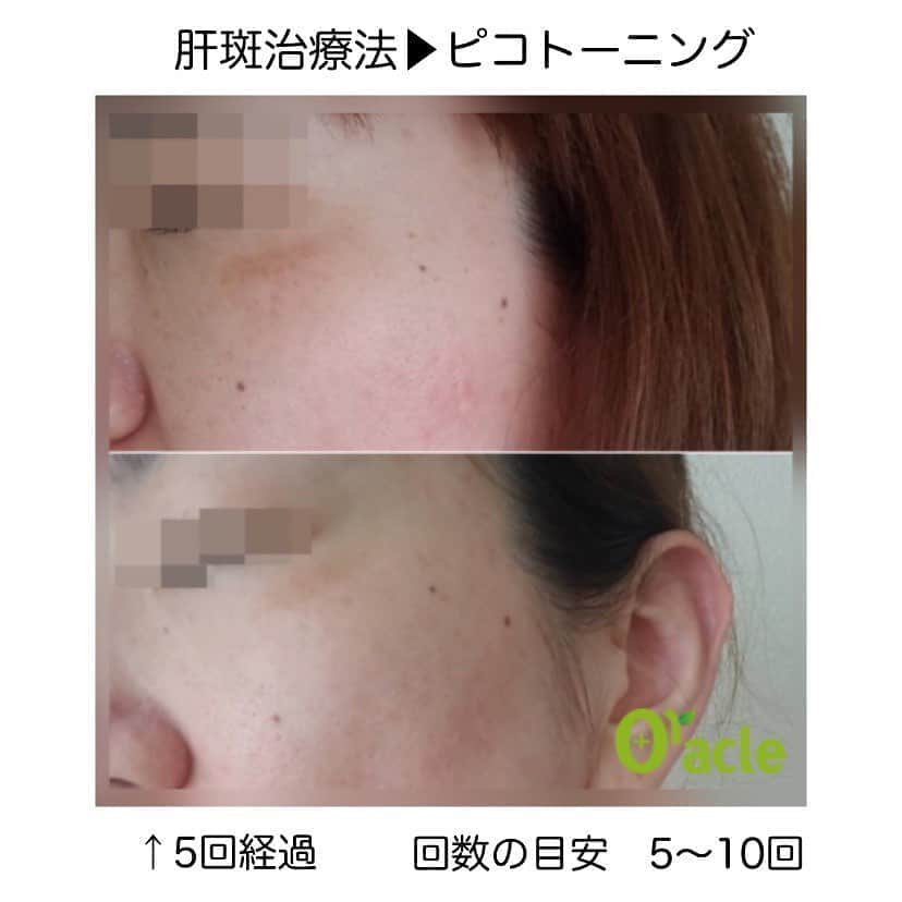 オラクル美容皮膚科東京新宿院さんのインスタグラム写真 - (オラクル美容皮膚科東京新宿院Instagram)「最近急増しているのがマスクによる肝斑‼️﻿ ﻿ 肝斑は正しい診断も大事‼️﻿ ﻿ 注）シミとは治療法が異なります。﻿ ﻿ シミの場合、オラクルでは﻿ ルメッカ、トーニング中心の治療を行います。﻿ YAGレーザーによるスポット照射もございます。﻿ ﻿ 肝斑の場合、オラクルでは﻿ トーニング中心の治療を行います。﻿ ※ルメッカは適応外﻿ ﻿ 内服や点滴のプラスも予防にもなりますので併用をおすすめしております。﻿ ﻿ シミ治療は信頼できるドクターに正しい診断からが大切‼️﻿ オラクルはお肌の専門ですので、なかなか治らないシミ、肝斑が疑われる方はご相談ください。﻿ ﻿ 【ルメッカ料金】﻿ トライアル全顔25,000円　※税抜﻿ ﻿ 【ピコトーニング】﻿ 全顔1回　32,000円　※税抜﻿ ﻿ コース割引ございます。﻿ ﻿ ルメッカ、ピコトーニングとも治療後のテープ保護不要。ダウンタイムを気にせずお受けいただけます。﻿ ﻿ ୨୧┈┈┈┈┈┈┈┈┈┈┈┈┈┈┈┈┈୨୧ ﻿ ﻿ 🇯🇵オラクル美容皮膚科🇰🇷﻿ 📍東京新宿院﻿ 新宿3丁目19-4 MLJ新宿8階﻿ ﻿ 📍名古屋院﻿ 名古屋市中区錦3丁目24−4 サンシャイン栄5階﻿ ﻿ 【専門】﻿ ニキビ（跡）／毛穴／シミ／しわ／たるみ／痩身／アンチエイジング／美白美肌治療全般／ブライダル相談／メンズ美容﻿ ﻿ 🗝完全予約制﻿ 👠土日祝日も診療﻿ ﻿ 【予約方法】﻿ ☎0120-905-696﻿ ⏰9:00～21:00［年中無休］﻿ ﻿ LINE、メール24時間📧﻿ LINE🆔 @oracle.jp ﻿ 📩HPメールフォームよりお願いいたします﻿ ﻿ #オラクル美容皮膚科  #シミ #肝斑 #そばかす #シミ取り #シミケア #シミ対策 #美肌 #美肌ケア #美肌作り #赤ら顔改善　#メンズ美容　#美白効果 #トーンアップ  #美容皮膚科 #美容 #美容好き #美容部 #美容好きな人と繋がりたい #美容好き #韓国美容 #韓国 #美容オタク　#ルメッカ　#ピコレーザー　#ピコトーニング﻿ ﻿」9月15日 9時55分 - oraclejp