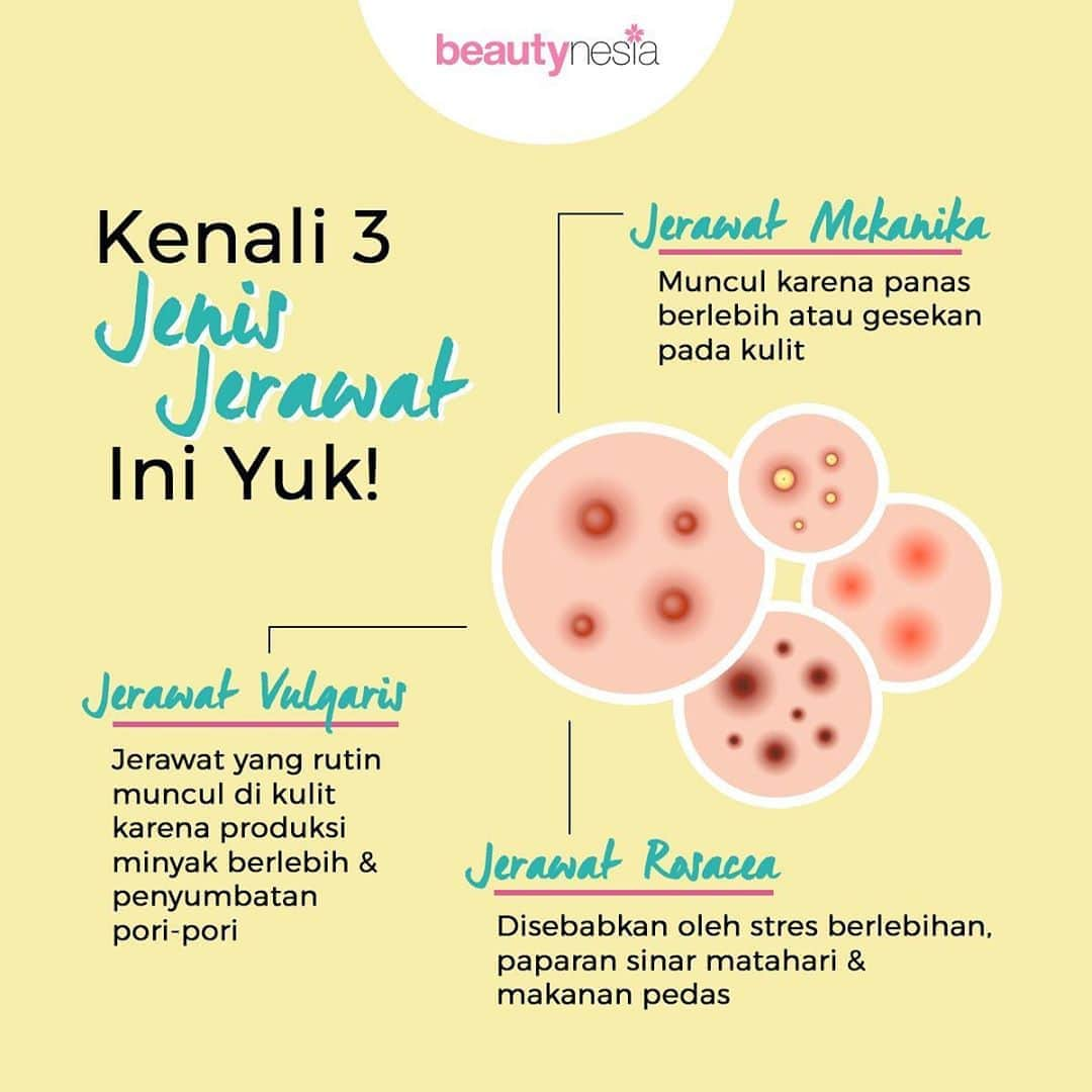 Beauty | Health | Fashionさんのインスタグラム写真 - (Beauty | Health | FashionInstagram)「Jerawat emang jadi salah satu masalah kulit yang sering dialami dan cukup menganggu. Nah ternyata jerawat juga ada jenis jenis nya lho. Simak yuk!⁣ ⁣ ✨Jerawat Vulgaris ⁣ Biasanya muncul pada periode remaja dan berlanjut hingga usia. Penyebabnya bisa karena kelebihan kelenjar minyak, perubahan hormonal atau kesalahan produk kosmetik.⁣ ⁣ ✨Jerawat Mekanika⁣ Kalo yang ini bisanya muncul karena panas yang berlebih atau gesekan pada kulit. Jerawat ini gak cuma muncul diwajah tapi bisa muncul di punggung atau bagian tubuh lainnya. ⁣ ⁣ ✨Jerawat Rosacea⁣ Biasanya jerawat Rosacea dialami oleh orang dewasa usia 30-50 tahun. Penyebabnya karena stres berlebih, terkea paparan sinar matahari dan juga konsums makanan pedas.⁣ ⁣ Nah, diantara jerawat ini istilah mana yang sering kamu denger ni ? Vulgaris, Mekanika, atau Rosacea ?⁣ ⁣ #BeautynesiaID #beautynesia #Acne #AcneProblem #AcneType #Acneskincare #Skincareroutine #Beautytips #Acnecare #Jerawat #MengatasiJerawata」9月15日 16時30分 - beautynesia.id