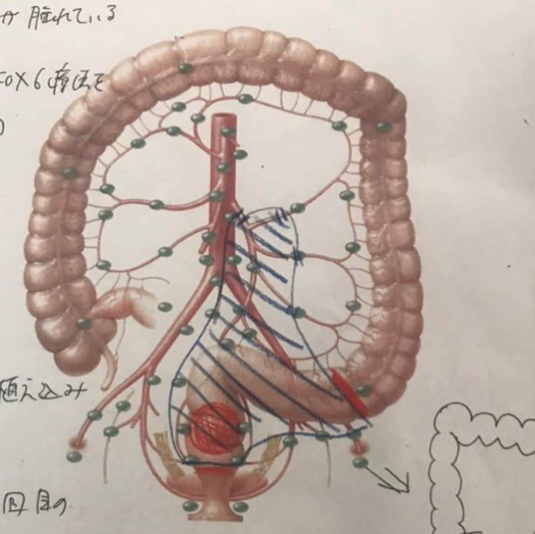 胃腸良子さんのインスタグラム写真 - (胃腸良子Instagram)「昨日は内視鏡センターでのお仕事。 深刻な進行大腸がんが発見されました。  ・  排便時いつも出血があったけれど、痔だと思い放置してしまったのだそうです。  ・  大腸がんは早期発見すれば、とても治療しやすいがんです。 まだ検査を受けたことがないと言う人は早めに受けましょう。  ・  改めて腸内環境の大切さを実感しました。 がんの原因となると言われている腸内細菌フソバクテリウム、どうしたら減少させることができるのか？ もっと勉強していきたいと思います。  ・  #がん検診 #大腸がん #看護師 #内視鏡技師 #健康第一  ・  💊サプリメントのご用命はtopページのリンク、またはDMからお問い合わせください👩‍⚕️  ＝＝＝＝＝＝＝＝＝＝＝＝＝＝＝＝＝＝  【ナースキュア】  ◆腸活サプリ　　 ビフィズス菌BB＋オリゴ糖　60錠　 定価8532円（税込） 初回購入価格　7452円（税込） ✨楽天リアルタイム1位取得 ✨累計販売数4万個突破！  ◆毛活サプリ ミレット&Lリジン 定価7560円（税込）　30日分 ✨AGAクリニック🏥で採用の成分。 ✨発売初日で初回生産分完売！  ＝＝＝＝＝＝＝＝＝＝＝＝＝＝＝＝＝＝  🏥ビタミン、ミネラル、他サプリメントは、病院採用サプリメント「ワカサプリ」を楽天ショップ「サプリメントナースキュア」で取り扱いしています。  ＝＝＝＝＝＝＝＝＝＝＝＝＝＝＝＝＝＝  健康のこと、胃腸のこと、アンチエイジングのこと、ご相談はDMまたはメールまで📩  ＝＝＝＝＝＝＝＝＝＝＝＝＝＝＝＝＝＝  #ビファズス菌 #乳酸菌 #腸活 #腸活サプリ #腸活美人 #プロバイオティクス #シンバイオティクス #便秘解消法 #便秘改善 #下痢 #薄毛 #薄毛治療 #薄毛女子 #薄毛改善」9月16日 6時36分 - kimiyo.f