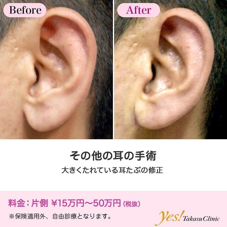 高須クリニックのインスタグラム：「👨🏻‍⚕️高須幹弥医師からのコメント✨⠀ 耳たぶが大きく垂れ下がっていた男性です。顔立ちは整っていたのですが、ここだけがコンプレックスでした。 耳たぶが大きく垂れ下がっているといえば、大仏さんをイメージします。穏やかな顔立ちにはなりますが、凛々しさには遠く、ピアスも決まりません。 手術で耳たぶを少し切除して縫い縮めると、耳全体がシャープに。顔の印象にも影響し、美しい顔立ちがさらに引き立つようになりました。 ---------------------------------------------------- 🌈料金✨⠀ ●その他の耳の手術 片側 ¥150,000~500,000【東京、横浜、名古屋、大阪】 ---------------------------------------------------- ⚠️リスク・副作用・合併症✨⠀ ●その他の耳の手術 手術後に処方する抗生剤や痛みどめによるアレルギー症状 仕上がりのわずかな左右差（完璧なシンメトリーは不可） --------------------------------------------------- 😊施術についての詳細✨⠀⠀ https://www.takasu.co.jp/photo/mimiother03.html ---------------------------------------------------- 📞ご予約・お問い合わせ✨⠀ 0120-5587-10⠀ https://www.takasu.co.jp/cgi-bin/form/contact.cgi ※症例写真や施術に関するご質問なども上記までお願い致します。 ---------------------------------------------------- #耳たぶの修正 #耳の手術  #皮膚 #美容 #美肌 #エイジングケア #美容整形 #美容外科 #美容クリニック #美容好き #美容皮膚科 #モニター #モニター募集 #高須クリニック #高須クリニック名古屋 #高須幹弥 #整形したい #プチ整形 #症例 #症例写真 #可愛くなりたい #可愛い #美人」