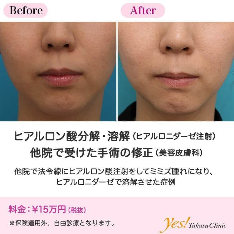 高須クリニックのインスタグラム：「👨🏻‍⚕️高須幹弥医師からのコメント✨⠀ 30代女性の患者様で、他院で安価なヒアルロン酸を左右のほうれい線に注射し、左側がミミズ腫れ状になり、不自然になっていたので、ヒアルロン酸分解酵素であるヒアルロニダーゼを注射しました。 当院のヒアルロニダーゼを注射すると、12~24時間程度でほとんどのヒアルロン酸は溶解してなくなります。 極細の注射針を使用するため、腫れはほとんど出ません。 1週間後に検診で来院されたときにはほとんど元通りになり、不自然さはなくなっていました。 現在、日本国内には様々なヒアルロン酸が出回っており、質の良い物もあれば安価で質の悪い物もあります。 異常に安い美容外科で、質の悪いヒアルロン酸を下手に注射されてしまうと、良くない結果になり、修正に費用がかかってしまうため、結果的に余計に費用がかかってしまいます。 高須クリニックでは、質の良いヒアルロン酸をベテランの医者が丁寧に注射させていただきます。 因みに、ヒアルロニダーゼも質の良いものと悪いものがあり、質の良いものは1回の注射で、ほとんどのヒアルロン酸を溶解することができますが、質の悪いものだと、ヒアルロン酸を溶解する力が弱いため、何回も注射する必要があることがあります。 高須クリニックではヒアルロニダーゼも質の良いものを使用しておりますので、心配ありません。 ---------------------------------------------------- 🌈料金✨⠀ ●ヒアルロン酸分解・溶解（ヒアルロニダーゼ注射） ¥150,000【全院】 ---------------------------------------------------- ⚠️リスク・副作用・合併症✨⠀ ●ヒアルロン酸分解・溶解（ヒアルロニダーゼ注射） 内出血（注射針が血管に当たってしまった場合） アレルギーが生じる可能性 --------------------------------------------------- 😊施術についての詳細✨⠀⠀ https://www.takasu.co.jp/photo/hyaluronjyokyo04a.html ---------------------------------------------------- 📞ご予約・お問い合わせ✨⠀ 0120-5587-10⠀ https://www.takasu.co.jp/cgi-bin/form/contact.cgi ※症例写真や施術に関するご質問なども上記までお願い致します。 ---------------------------------------------------- #ヒアルロン酸分解 #ヒアルロン酸溶解 #ヒアルロニダーゼ注射 #他院で受けた手術の修正 #皮膚 #美容 #美肌 #エイジングケア #美容整形 #美容外科 #美容クリニック #美容好き #美容皮膚科 #モニター #モニター募集 #高須クリニック #高須クリニック名古屋 #高須幹弥 #整形したい #プチ整形 #症例 #症例写真 #可愛くなりたい #可愛い #美人」