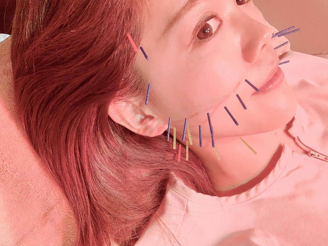 上坂由莉のインスタグラム：「﻿ ﻿ こんばんは🌙﻿ 昨日は月一の美容鍼へ行ってたよ💆‍♀️ @sbc.tokyo  まずは背中、肩、首回りの凝り改善に﻿ 身体へ鍼を打ってもらってからお顔の鍼に😚﻿ ﻿ ﻿ 今回は顔の下半身のたるみ改善に﻿ 頬下に多く打ってるのわかりますかね❓❤️﻿ ﻿ ﻿ たるみやコリの左右差があったようで﻿ 鍼の打ち方も左右でバランスが違います🙆‍♀️﻿ ﻿ ﻿ 全体的な歪みなどはほぼなくもう２年近く通って﻿ 戻りがだんだん少なくなって本当嬉しい〜🥺💓﻿ 実は鞭打ちもあったから今月は２回行ってたの☺️﻿ 先生の解剖学の知識や美容の知識は﻿ 本当に毎回勉強にもなるし、楽しい〜😍﻿ 行くだけで気持ちも上がるから毎回ウキウキです🥰﻿ 来月も予約取ってから帰ったし楽しみっ💓﻿ ﻿ ﻿ #世田谷ビューティクリニーク #美容鍼 #鍼灸治療院 #鍼灸院﻿ #池尻大橋 #世田谷 #東洋医学 #小顔調整」