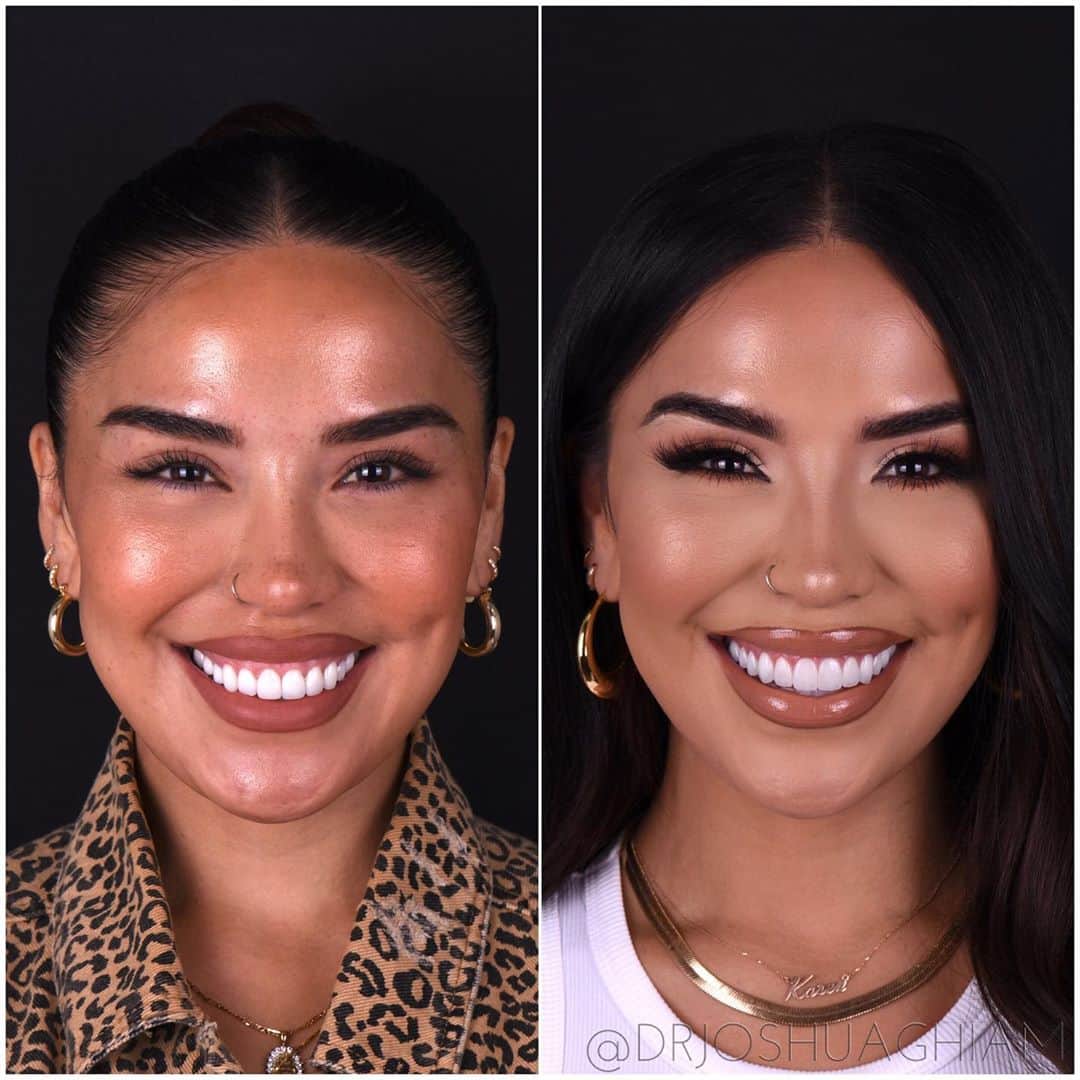 iluvsarahiiさんのインスタグラム写真 - (iluvsarahiiInstagram)「It’s the new teeth for me 🦷👏🏼 swipe to see my veneer transformation because it’s AMAZING!!! Thank you to @drjoshuaghiam for seriously transformation my smile. I still can’t get over how natural and real they look, I’m obsessed!!! I will have a video going up soon that is all about my veneers! Stay tuned 💗」9月18日 2時00分 - iluvsarahii