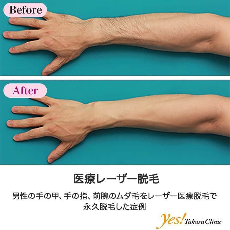 高須クリニックのインスタグラム：「👨🏻‍⚕️高須幹弥医師からのコメント✨⠀ 30代男性で、手の甲、指、前腕のムダ毛を気にされていました。 診察させていただいたところ、手の甲はとくに小指側、手の指は第二関節より中枢側、前腕は全体的に硬毛（うぶ毛ではなく、太くて硬い毛のこと）が生えていました。 レーザー医療脱毛機械であるダイオードレーザーを、2ヶ月おきに照射することになりました。 治療する度に毛は薄くなり、8回目が終了した時点ではかなり薄くなったため、治療を終了しました。 医療脱毛であるダイオードレーザーは永久脱毛であるため、なくなった毛がまた生えてくることはありません。 手の甲、手の指、前腕のムダ毛は、半袖を着れば露になるため、非常に目立ちやすい部位です。 多少毛が生えている程度ならよいですが、あまりに剛毛だと、毛嫌いする女性もいるため（特に10~20代の若い女性）、気にしている人はレーザー医療脱毛で永久脱毛するのが良いと思います。 ---------------------------------------------------- 🌈料金✨⠀ ●医療レーザー脱毛 手の甲～指 1回毎	￥10,000【東京、横浜、名古屋、栄】 ※この部位のフリープランはございません。 ●医療レーザー脱毛　上腕または前腕（両腕）／各 初回~5回目までの1回毎 ¥29,000 / 1年間フリープラン ¥138,000【全院】 ※「1年間フリープラン」は上限8回までの施術とさせていただきます。 ---------------------------------------------------- ⚠️リスク・副作用・合併症✨⠀ ●医療レーザー脱毛 肌のほてり・発赤（照射後／肌が弱い方・敏感肌の方） 日焼けした肌に脱毛レーザーを照射すると火傷のリスク 照射後間もない時期に日焼けをすると、シミや色素沈着 一時的な毛嚢炎 --------------------------------------------------- 😊施術についての詳細✨⠀⠀ https://www.takasu.co.jp/photo/epi12.html ---------------------------------------------------- 📞ご予約・お問い合わせ✨⠀ 0120-5587-10⠀ https://www.takasu.co.jp/cgi-bin/form/contact.cgi ※症例写真や施術に関するご質問なども上記までお願い致します。 ---------------------------------------------------- #医療レーザー脱毛 #レーザー医療脱毛 #レーザー脱毛 #永久脱毛 #手の甲のムダ毛 #手の指のムダ毛 #前腕のムダ毛  #皮膚 #美容 #美肌 #エイジングケア #美容整形 #美容外科 #美容クリニック #美容好き #美容皮膚科 #モニター #モニター募集 #高須クリニック #高須クリニック名古屋 #高須幹弥 #整形したい #プチ整形 #症例 #症例写真 #可愛くなりたい #可愛い #美人」