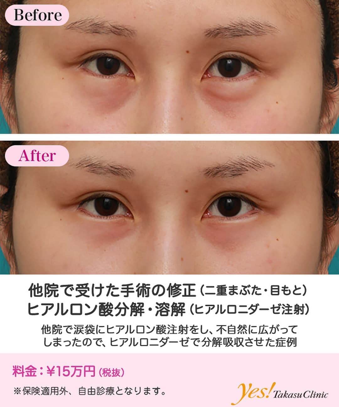 高須クリニックのインスタグラム：「👨🏻‍⚕️高須幹弥医師からのコメント✨⠀ 20代女性の患者様で、他院で涙袋にヒアルロン酸を注射しており、それが気に入らなくて来院されました。 診察させていただいたところ、涙袋に適していない柔らかいヒアルロン酸を注射されているためか、注入した医者の技量によるものなのか、あるいはその両方なのか、ヒアルロン酸が縦に広がって不自然になっていました。 特に左側の涙袋に注入されたヒアルロン酸が広がっており、左右差も酷い状態でした。 ヒアルロニダーゼを注射し、ヒアルロン酸を分解、溶解、吸収させることになりました。 下まぶたの皮膚に麻酔クリームを塗った後、左右の涙袋に注入されているヒアルロン酸に、ヒアルロニダーゼを約0.5ccずつ注入しました。 ヒアルロニダーゼ注入した翌日にはほとんどヒアルロン酸は分解、溶解、吸収され、大きな腫れも引いて、自然になりました。 1週間後に検診にいらしたときにはほぼ完全に元の下まぶたに戻っていました。 涙袋のヒアルロン酸注射は、ある程度の密度と張りのある涙袋専用のヒアルロン酸を用いなければなりません。 涙袋専用ではない柔らかいヒアルロン酸を用いると、この患者様のように、縦に流れて広がってしまい、幅のひろい不自然な目袋のような涙袋になってしまいます。 また、他院で失敗された涙袋のヒアルロン酸をヒアルロニダーゼで分解、溶解、吸収させた後、涙袋専用のヒアルロン酸を正しく注入すれば、綺麗で自然な涙袋を作ることができますが、その場合、私に関しては、1週間間隔を空けるようにしています。 ---------------------------------------------------- 🌈料金✨⠀ ●ヒアルロン酸分解・溶解（ヒアルロニダーゼ注射） ¥150,000【全院】 ---------------------------------------------------- ⚠️リスク・副作用・合併症✨⠀ ●ヒアルロン酸分解・溶解（ヒアルロニダーゼ注射） 内出血（注射針が血管に当たってしまった場合） アレルギーが生じる可能性 --------------------------------------------------- 😊施術についての詳細✨⠀⠀ https://www.takasu.co.jp/photo/hyaluronjyokyo09.html ---------------------------------------------------- 📞ご予約・お問い合わせ✨⠀ 0120-5587-10⠀ https://www.takasu.co.jp/cgi-bin/form/contact.cgi ※症例写真や施術に関するご質問なども上記までお願い致します。 ---------------------------------------------------- #他院で受けた手術の修正 #ヒアルロン酸分解 #ヒアルロン酸溶解 #ヒアルロニダーゼ注射 #涙袋の修正  #皮膚 #美容 #美肌 #エイジングケア #美容整形 #美容外科 #美容クリニック #美容好き #美容皮膚科 #モニター #モニター募集 #高須クリニック #高須クリニック名古屋 #高須幹弥 #整形したい #プチ整形 #症例 #症例写真 #可愛くなりたい #可愛い #美人」