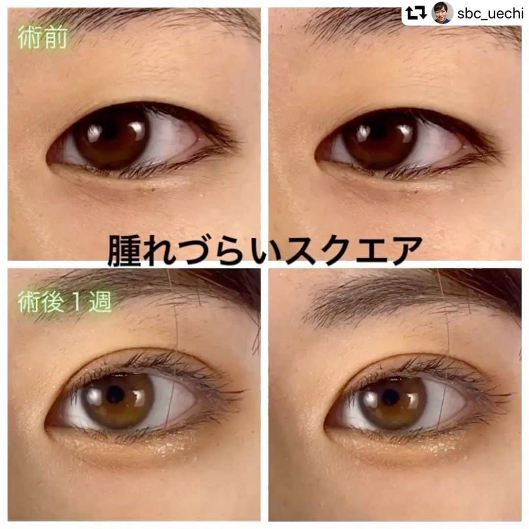 湘南美容外科 柏院さんのインスタグラム写真 - (湘南美容外科 柏院Instagram)「#repost @sbc_uechi ・・・ 腫れづらいスクエア（埋没）を受けて頂いたモニターの方の術後経過です! 末広二重希望でした。 もともと一重ですが、目の開きは悪くない方でしたので、末広になる範囲内で二重幅は少し広めにしました！  二重手術をご検討の方は、是非湘南美容クリニックにご相談ください(^^)  気になる質問等ございましたら、DMで質問またはご来院ください🤗  電話でご予約の際は「上地のインスタを見た」とお伝えください！  🏥湘南美容クリニック柏院 📞0120-489-750  【腫れづらいスクエア　期間限定モニター料金】 ⭕️両目　49000円⭕️  ※腫れづらいスクエアは腫れづらいですが全く腫れないわけではありませんので、手術を受ける際はダウンタイムを考慮してお受けください。  ※瞼の皮膚のたるみ、蒙古襞、瞼の厚みの程度によっては また、手術には二重線の左右差、感染、内出血、術後の腫れ、埋没糸の露出、二重線の消失、予定外二重線等といった合併症・リスクがあります。その他の詳細については御来院された際に説明致します。  #美容 #美容整形 #湘南美容クリニック #湘南美容外科 #湘南美容クリニック柏院 #二重 #末広二重　 #平行二重 #二重術 #埋没 #湘南二重術 #週末二重術 #腫れづらいスクエア二重術  #モニター #モニターモデル募集  #ダウンタイム #ヒアルロン酸 #ボトックス #可愛い #美人　 #美女 #綺麗  #アイメッド #オンライン診療 #オンライン相談 #若返り美容 #エイジングケア湘南 #たるみ改善湘南 #たるみ治療は湘南」9月18日 16時06分 - sbc_kashiwa