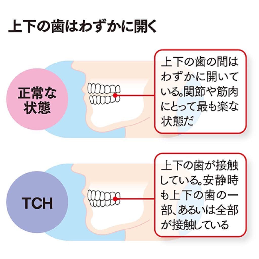 kogao283さんのインスタグラム写真 - (kogao283Instagram)「エラが張りやすい方は ぜひご確認ください👩‍🏫  歯列接触癖【TCH】ってご存知ですか？  Tooth Contacting Habit    通常は、上下の歯は離れています。 噛み合い、接触するのは飲食のときと話すときで、 それは1日のうち合計20分間以下だといわれています。 そのほかの時間は、上下の歯の間には1～3mm程度のすき間があるのです。     TCHとは、無意識のうちに上の歯と下の歯を接触させ続けてしまう癖。  私のストーリーズのアンケートでは 接触癖の疑いがある方57％！！ サロンのお客様でも凡そ半数も 接触癖の方がいらっしゃいました😓  強い力ではありませんが、 長時間、上下の歯が接触している状態が続くので、  お口の中にさまざまな悪影響を与えるリスクがあります。  集中しているときや緊張しているときなどに、 無意識に歯にグッと力を込めてしまう…… そんな自覚のある方は要注意です。     TCHによって自分の歯や体に影響する例が いくつかあるので、紹介していきたいと思います。  #奥歯や前歯がすり減る  #エラが張る  歯ぎしりをすると口まわりの筋肉、 いわゆるエラあたりの筋肉にある咬筋などに 強い負荷がかかります。  睡眠中に歯ぎしりをしている人は、 例えるなら咬筋の筋トレを一日中しているような状態にあります。 そうすると咬筋や下あごの骨が発達し、 エラが張ってくることがあります。  #頭痛や肩こりにつながる #歯の位置が移動する・歯並びが変化する #歯周病の悪化につながる #顎関節症の原因になる #口内で下あごや上あごの骨がふくらんだり出っ張ったりする  改善策  とにかく 意識的に接触癖をなくす！  歯の接触は体に良くないことと自覚しよう。  「歯を離す」と気付かせてくれるスマホの壁紙や 文字や絵をかいた紙を１０カ所以上にはること。 少しでも 歯や周辺の筋肉に負担ないように意識しましょう。」9月19日 16時41分 - kogao283