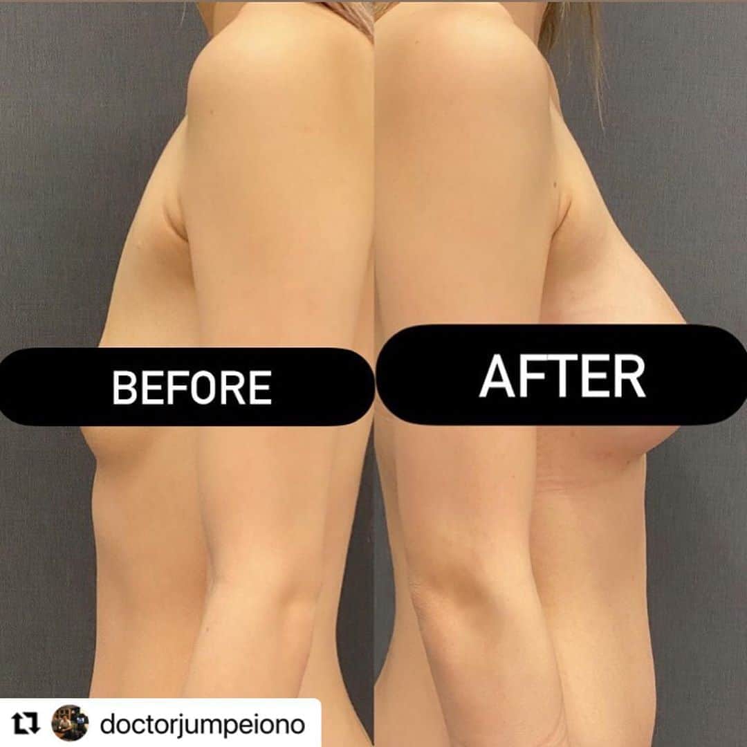 東京美容外科公式のインスタグラム：「#Repost @doctorjumpeiono with @make_repost ・・・ ベラジェル275ccを入れてます。 元のバストが小さい方、痩せ型の方、出来るだけ自然なラインになるように、デュアルプレーン法やハイブリッド法など駆使しますが、必要ない方には勧めません。 この方は乳輪乳頭が隠れていてわかりづらいですが、小さいながらも若干の下垂による皮膚の余裕があったので、乳腺下法で行いました。 毎年秋には、とりあえず夏にヒアルロン酸で豊胸したけどすぐ無くなっちゃった・・と言った相談が増えます。 シリコンインプラントによる豊胸術は人工物を使用する手術です。 稀ですが血腫や感染により再手術を要するなどのリスクがあります。 カウンセリングでは具体的なリスクの説明も行います。 #小野准平 #東京美容外科 #豊胸 #シリコン豊胸 #デュアルプレーン豊胸 #ハイブリッド豊胸 #ヒアルロン酸豊胸 #バストアップ #ナイトブラ #くびれ作り #ダイエット #ボディメイク #ドレス #水着 #ビキニ #ナイトプール #新宿 #歌舞伎町 #キャバクラ #キャバ嬢 #ホステス #ギャル #ダンサー」
