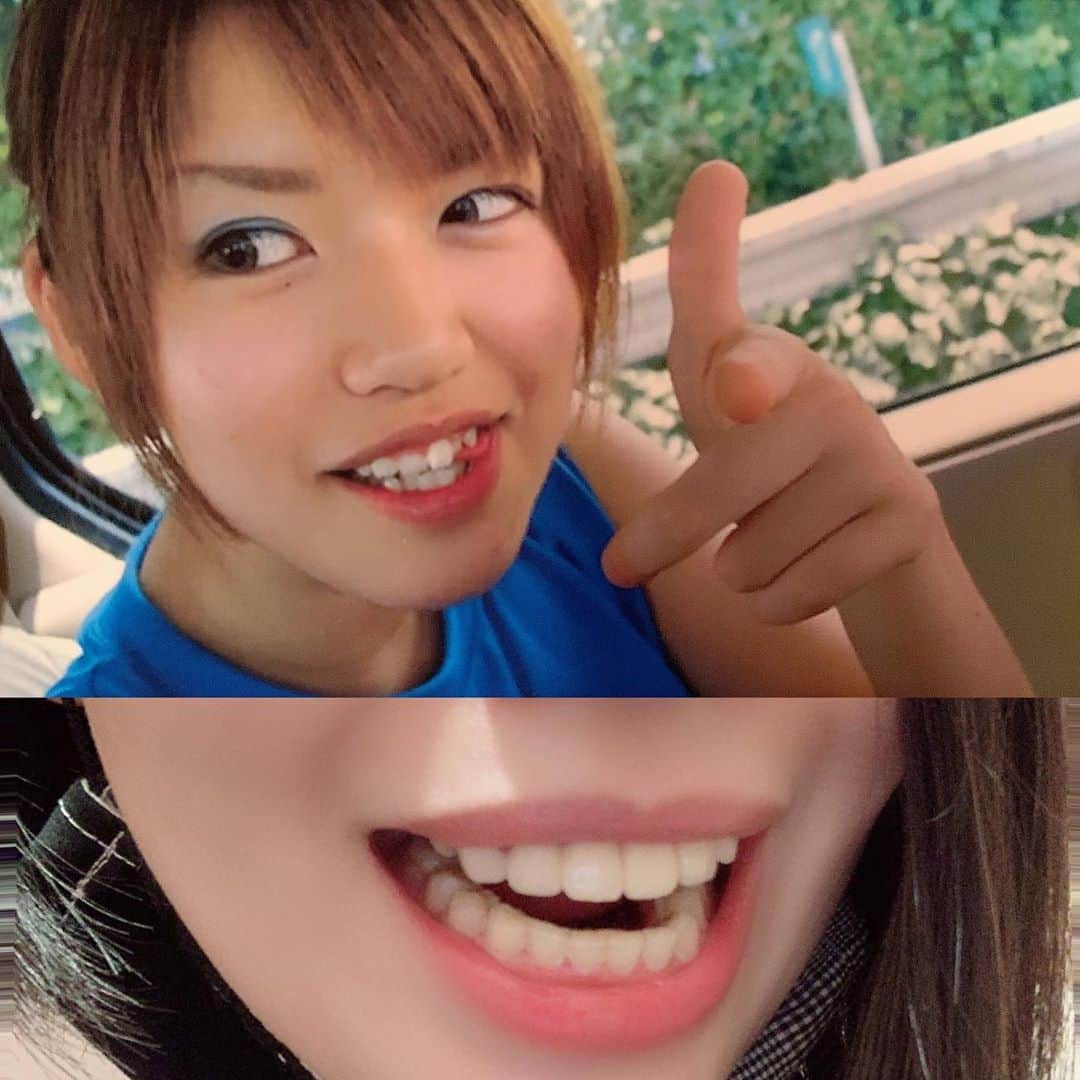 のインスタグラム：「歯列ポスト。下の歯のBefore Afterは前に載せましたが、上の歯は比較していませんでしたね。 高校三年生の夏、野球部の応援に行った帰りの写真に元の歯並びがしっかり写っていたので比較。 コンプレックスだったのであまり歯が出ている写真がなくてやっと見つけました。ガッタガタや！ 下の歯の部分矯正をしたのは昨年ですが、上の歯はよく見えるので22歳の頃に先に改造しました。 見ての通り、元の歯はとても小さく縦にも短かったので、自分の歯よりも縦に長い差し歯を前歯6本分作って貰い、その分歯茎を切って短くした所に嵌めました。 これを最初にやってくれた歯医者さんがヤブで、上の歯6本の連結の差し歯が外れてしまうようになり、作り直して貰おうと思ったら歯医者がなくなっていました。笑 お友達のお父様が腕の良い歯医者さんで、そこで今のしっかりしたものに作り替えていただき、それからはトラブルなしです。 というわけで、私の場合上の歯はセラミック、下の歯は普通の矯正、という成り立ちです。 #歯列矯正 #セラミック矯正 #あとどうでも良いけど #高校生時代 #眉毛の角度 #すごい」