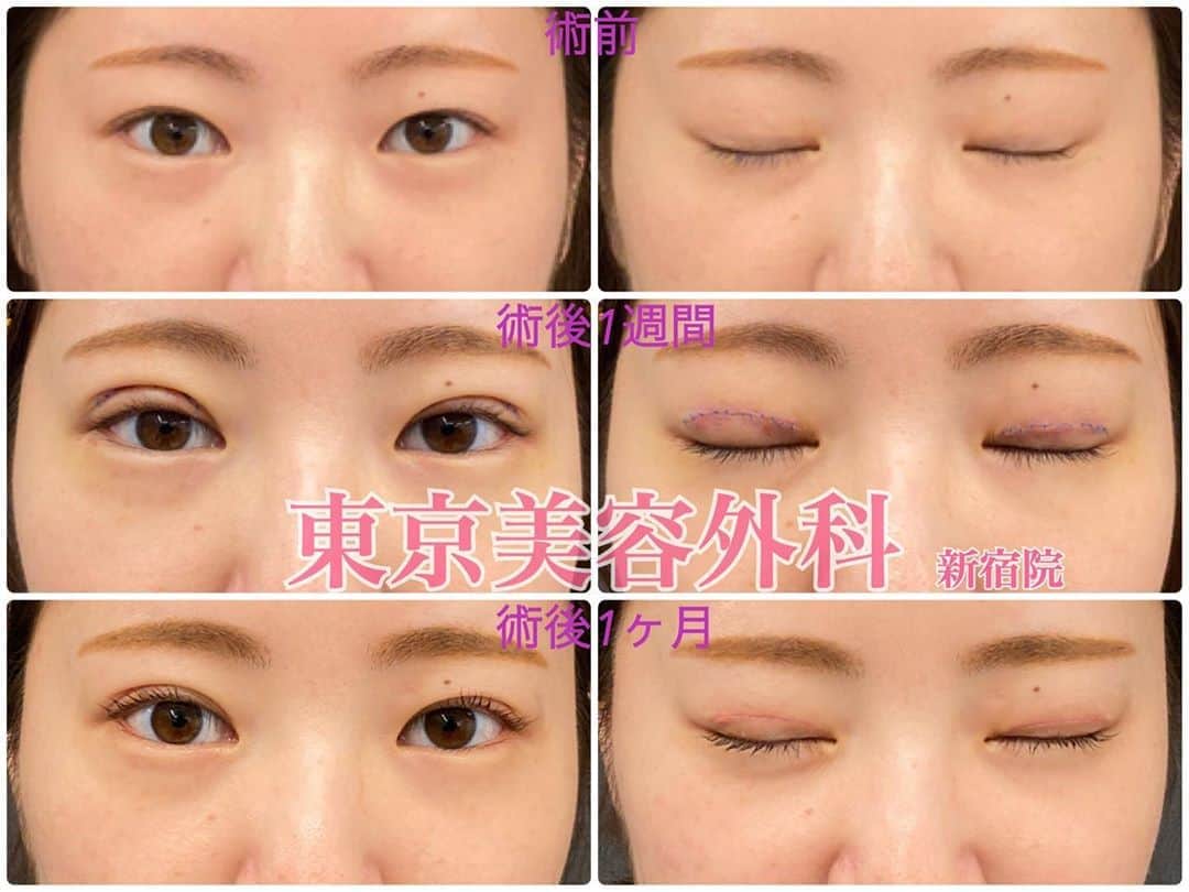 東京美容外科公式のインスタグラム：「東京美容外科 新宿院です✨ ・ こちらは二重全切開した方の症例写真です！ ・ 数年前に埋没法をしており、最近二重幅が狭くなったのが気になり幅を広げるための修正を目的に手術されました。 末広型でなるべくナチュラルにしたい！という本人の希望どおりになっております👏 ・ こちらの執刀医は冨田ドクターです🌟 目元のオペの症例数も多くスタッフからも大変信頼されております😊！！ ・ ⚠️リスクと術後の注意点⚠️ 平均的な腫れは術後2〜3日がピークで1〜2週間かけて腫れが徐々に引いていきます。 内出血が出た場合も赤紫→黄色→肌色と1〜2週間かけて戻っていきます。 抜糸は1週間後に行っております。 ・ ・ ・ =====🎁お問い合わせはこちら🎁===== 詳しくはプロフィールURLから公式サイトへ♪ ▼フリーダイヤル 0120-658-958 （コールセンター受付時間・9:00〜21:00） ▼LINE予約 @tkc110  @dr.tomita___official  =================== #東京美容外科 #新宿院 #美容外科 #整形 #手術 #二重切開 #二重切開経過 #美容 #美容整形 #キャバクラ #ホスト」